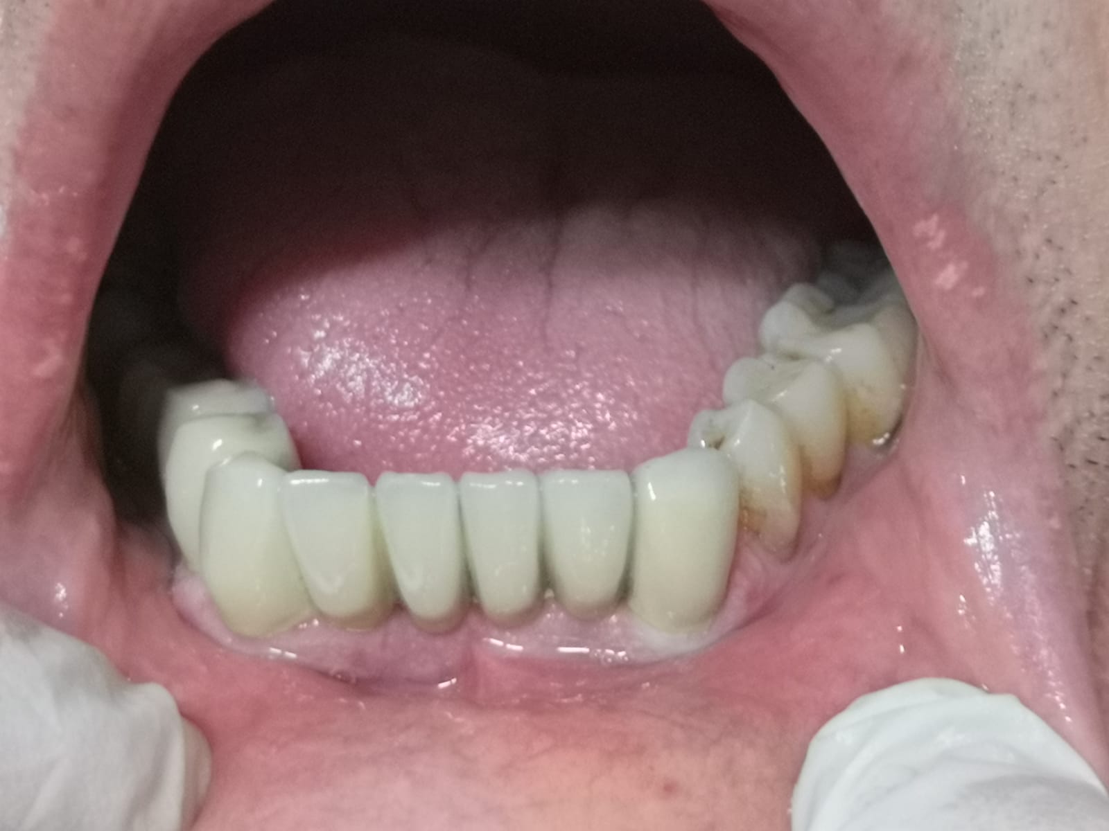 Stato dopo l'applicazione di una protesi fissa