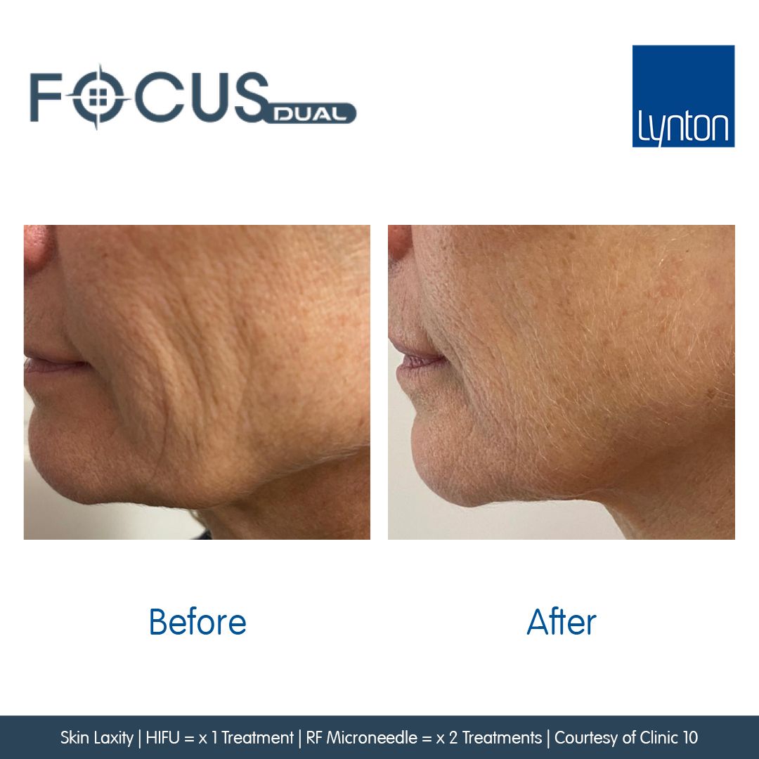 Ladies jawline following a treatment of Hifu and RF Microneedling using the Focus Dual