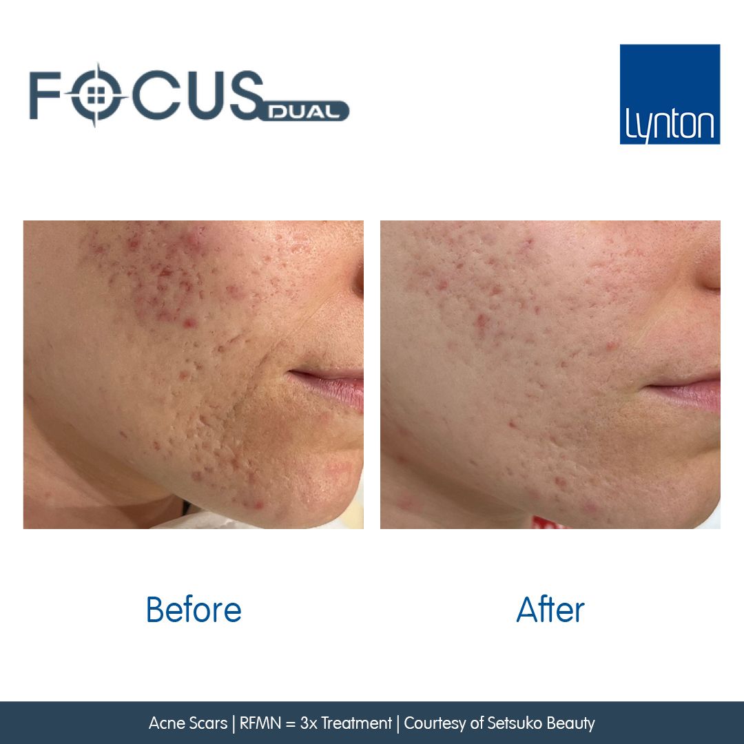 mazing Acne Scaring treatment results