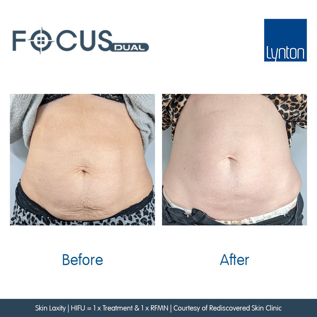Skin Laxity on a ladies stomach treated with Hifu and Radifrequency Microneedling Focus Dual®