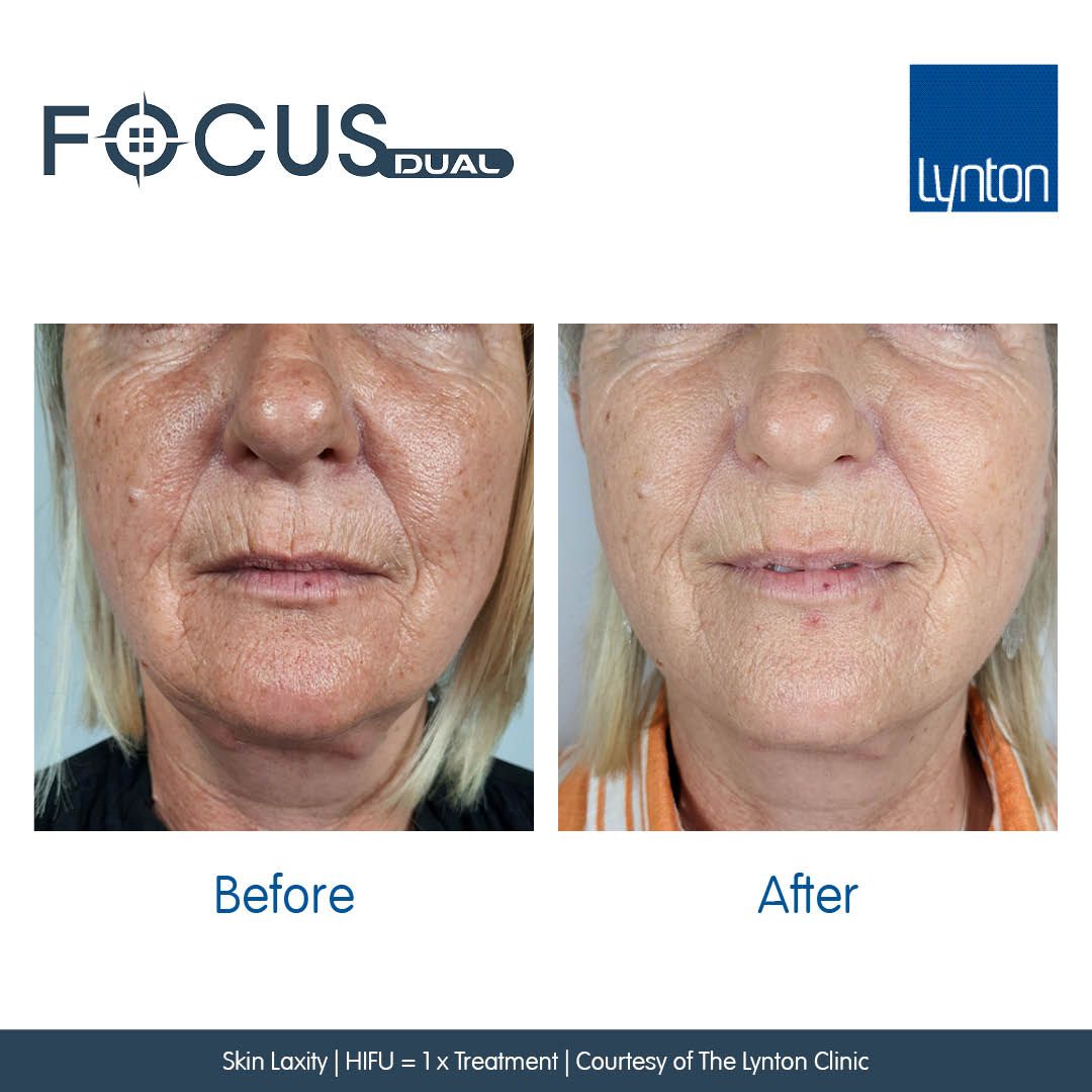 Ladies Facial Skin Laxity after 1 HIFU treatment.