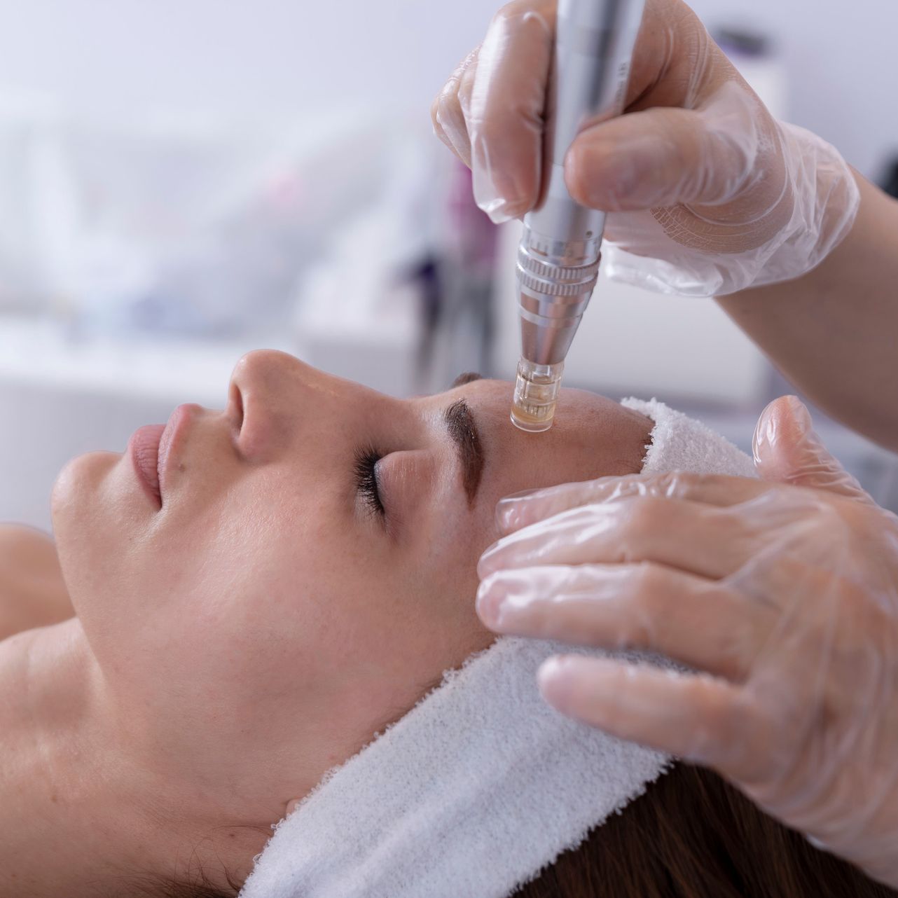 Femme recevant un traitement de microneedling du visage. L'esthéticienne tient l'appareil sur son front.