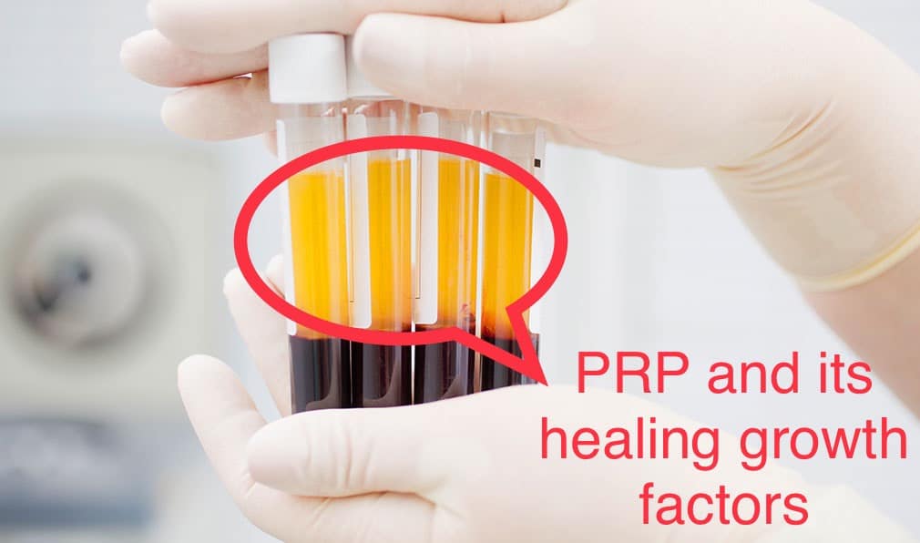 PRP Therapy and its healing Growth factors