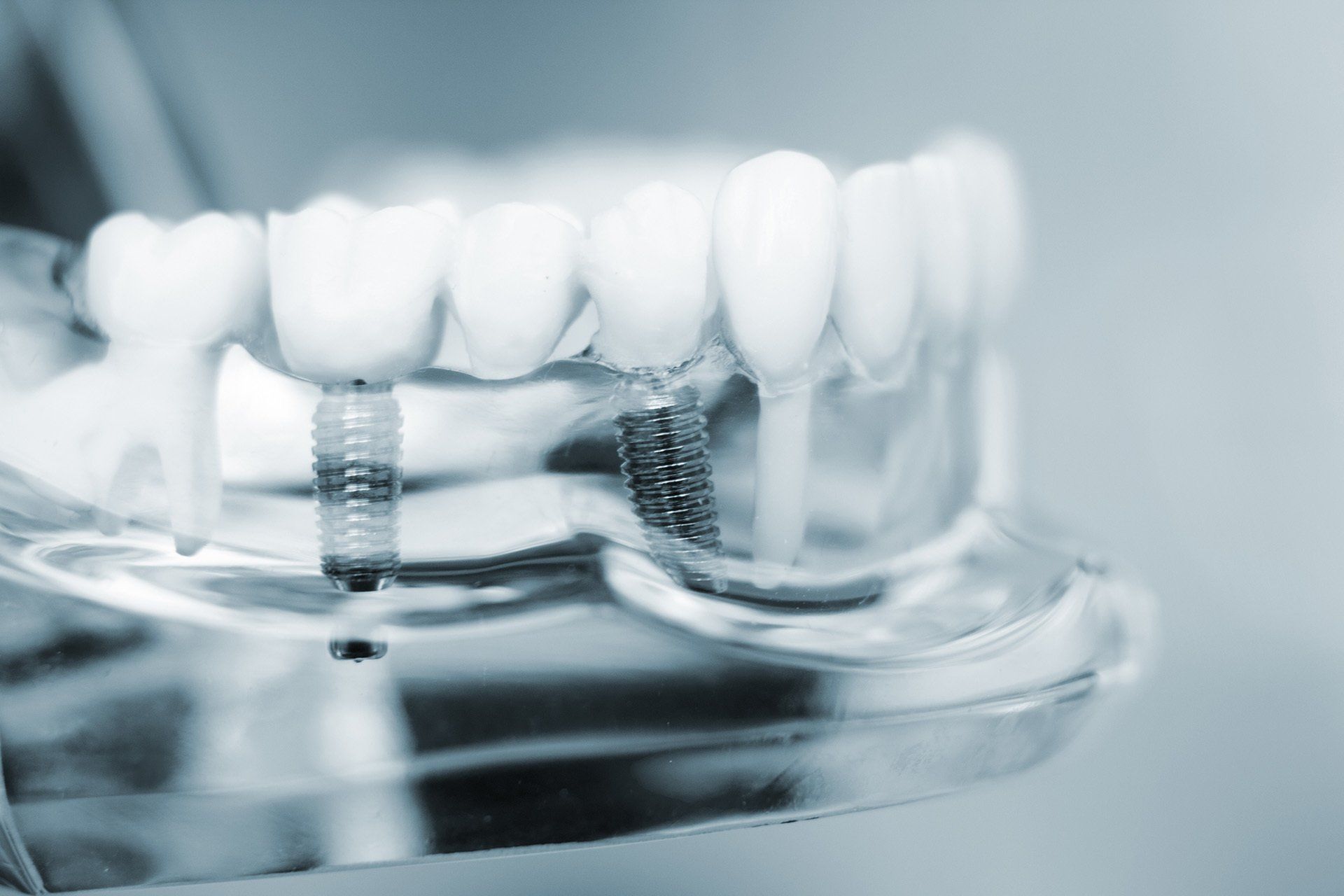 modello di un impianto dentale