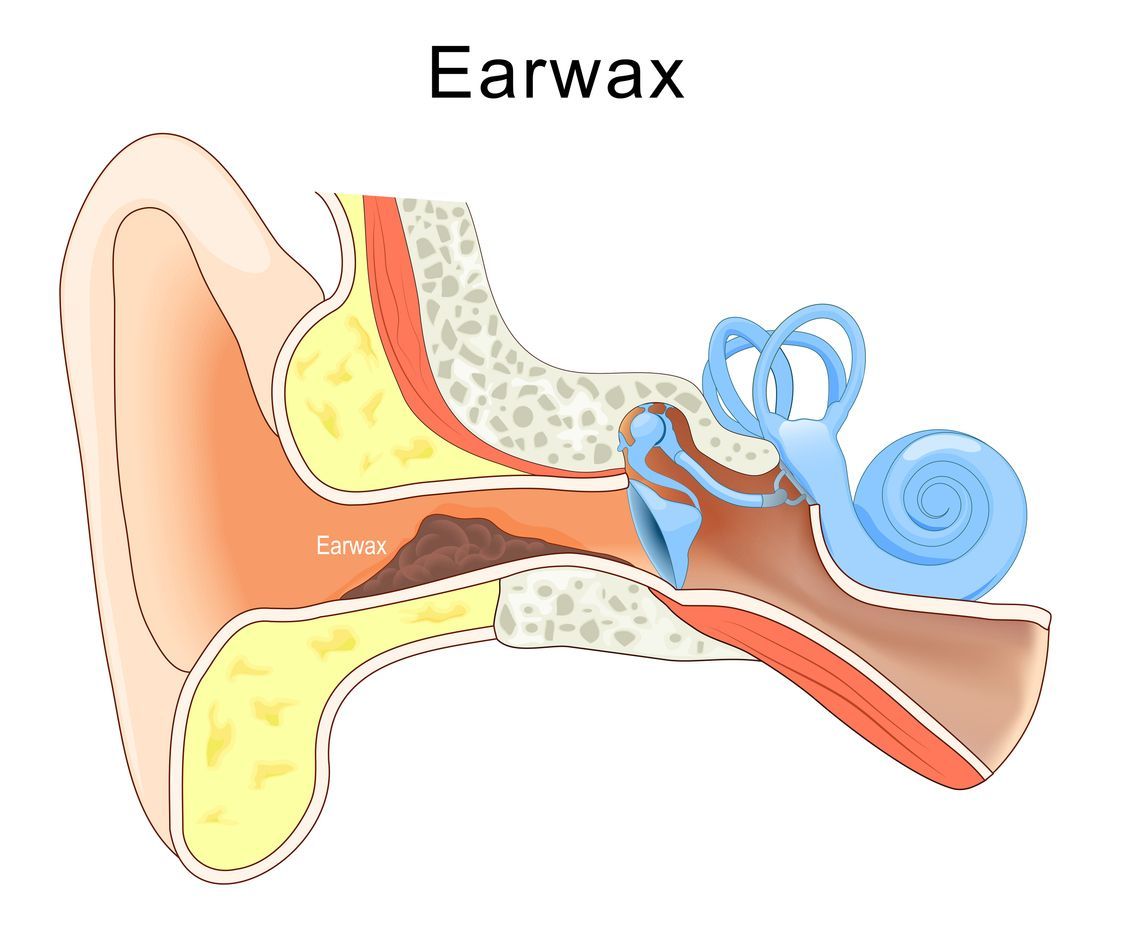 A diagram of the inside of an ear showing the ear wax
