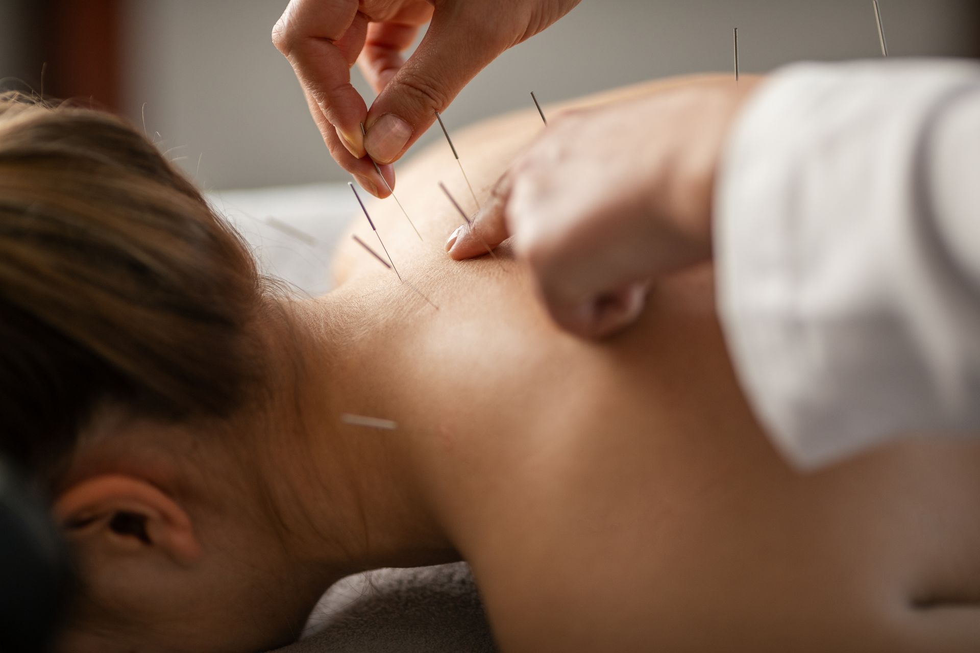 A woman is getting an acupuncture treatment on her back.