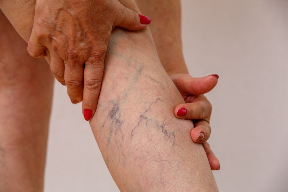 A Woman With Red Nails Is Holding Her Leg With Spider Veins — Mackay Skin Clinic In North Mackay, QLD