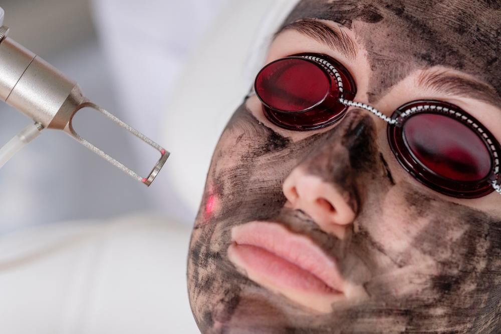 A Woman Is Getting A Laser Treatment On Her Face — Mackay Skin Clinic In North Mackay, QLD