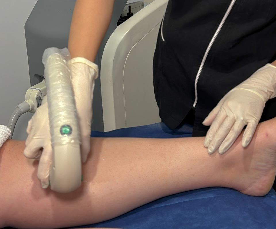 IPL Hair Removal On Legs
