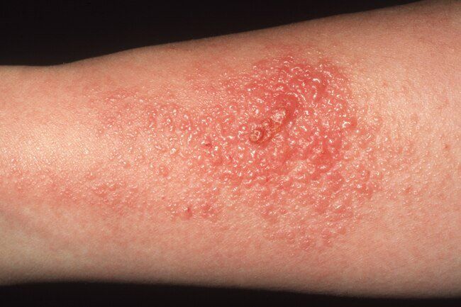 A close up of a person 's arm with a rash on it.