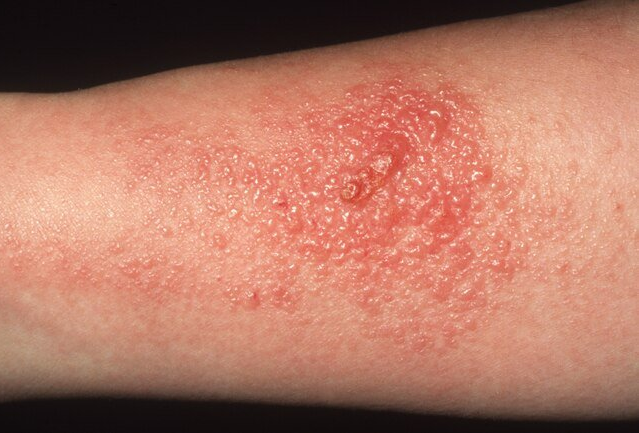 Red, raised rash on a person's arm.