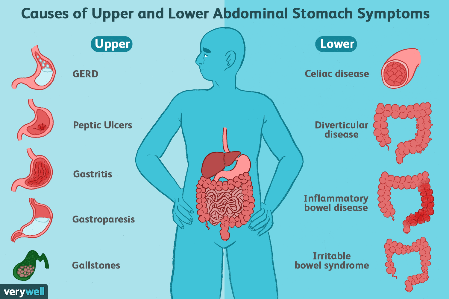 A diagram of the causes of upper and lower abdominal stomach symptoms