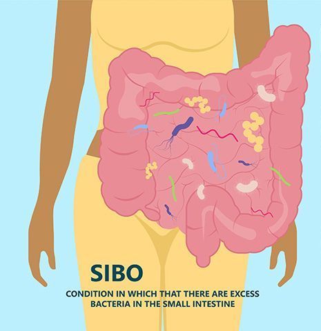 A diagram of a small intestinal bacterial overgrowth.