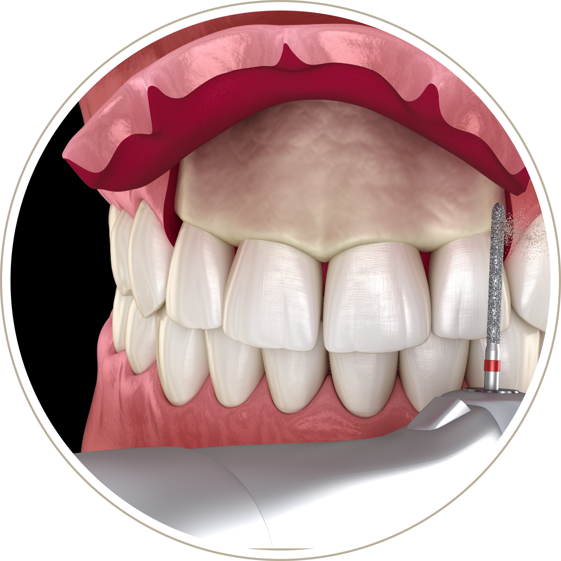 A computer generated image of a person 's teeth with dental implants.