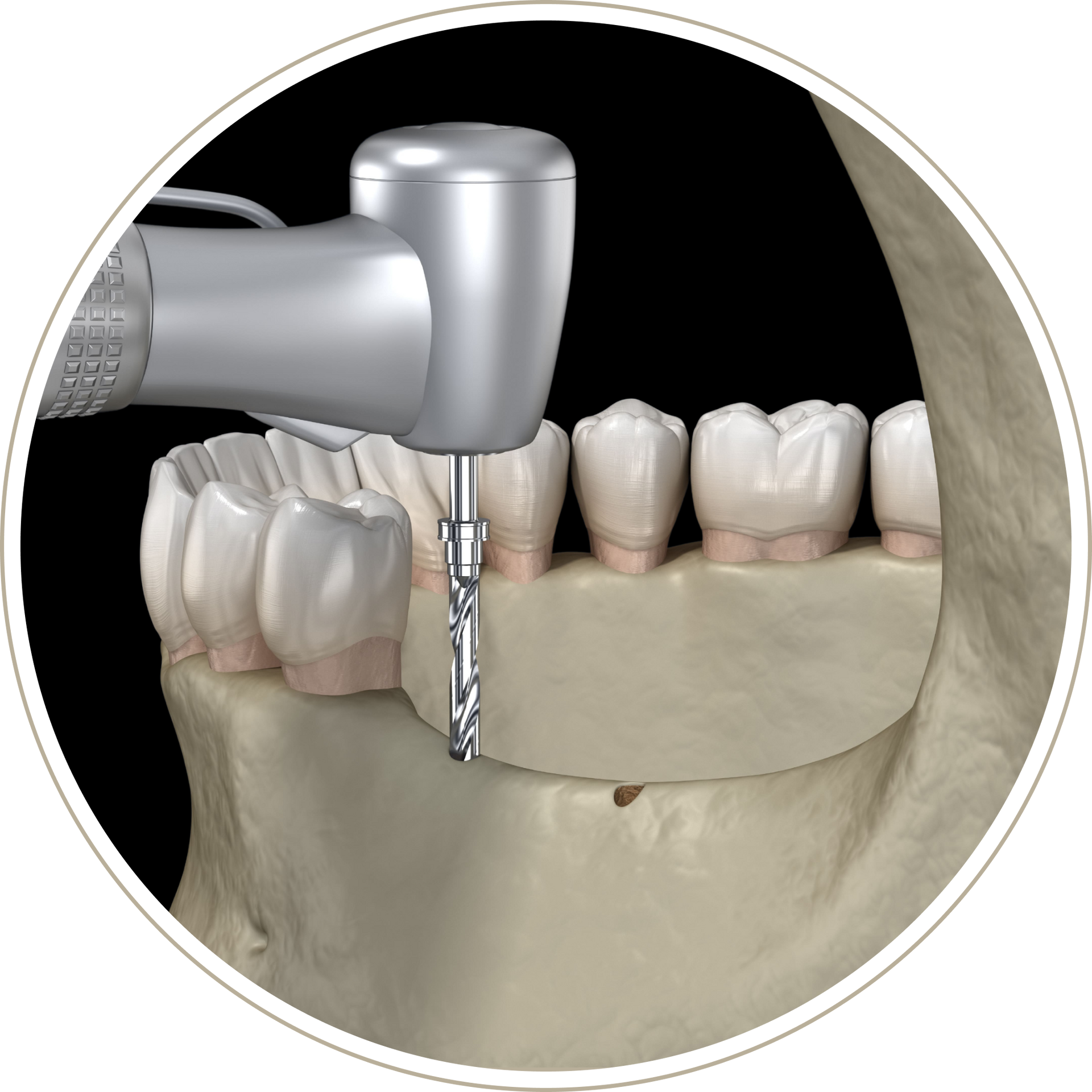 A computer generated image of a person 's teeth with dental implants.