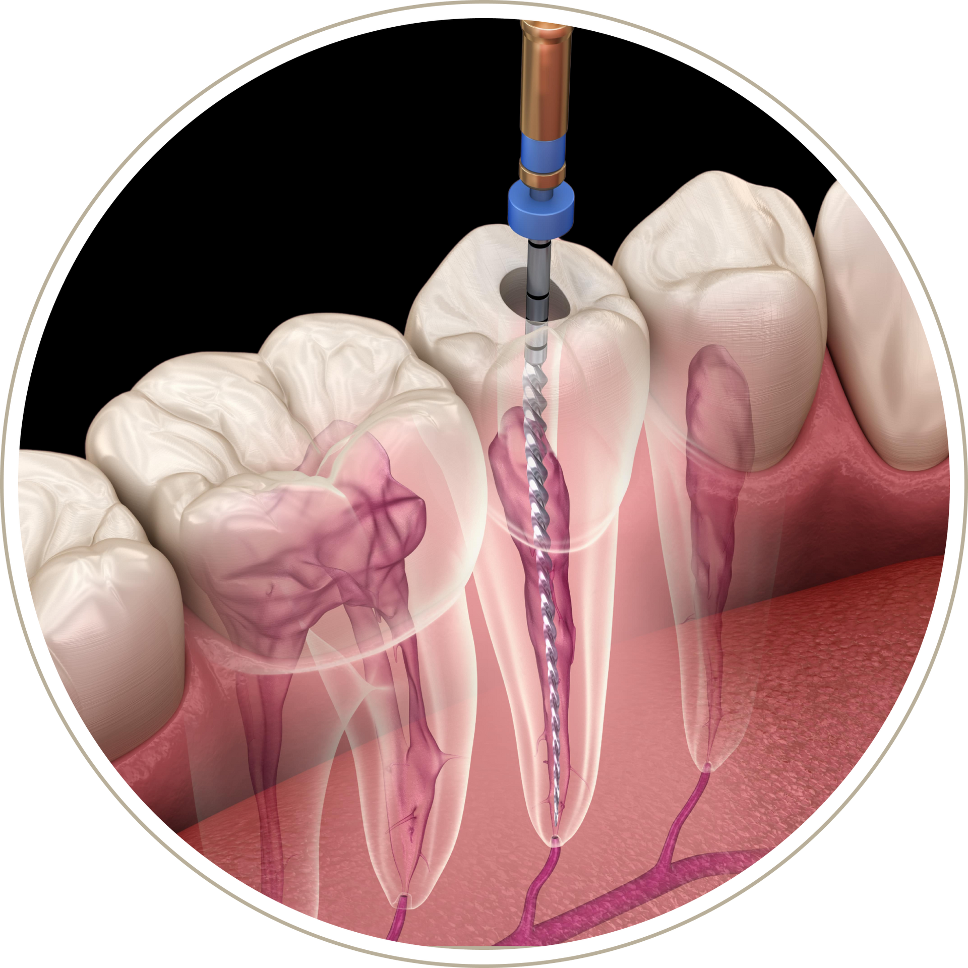 A computer generated image of a person 's teeth with dental implants.