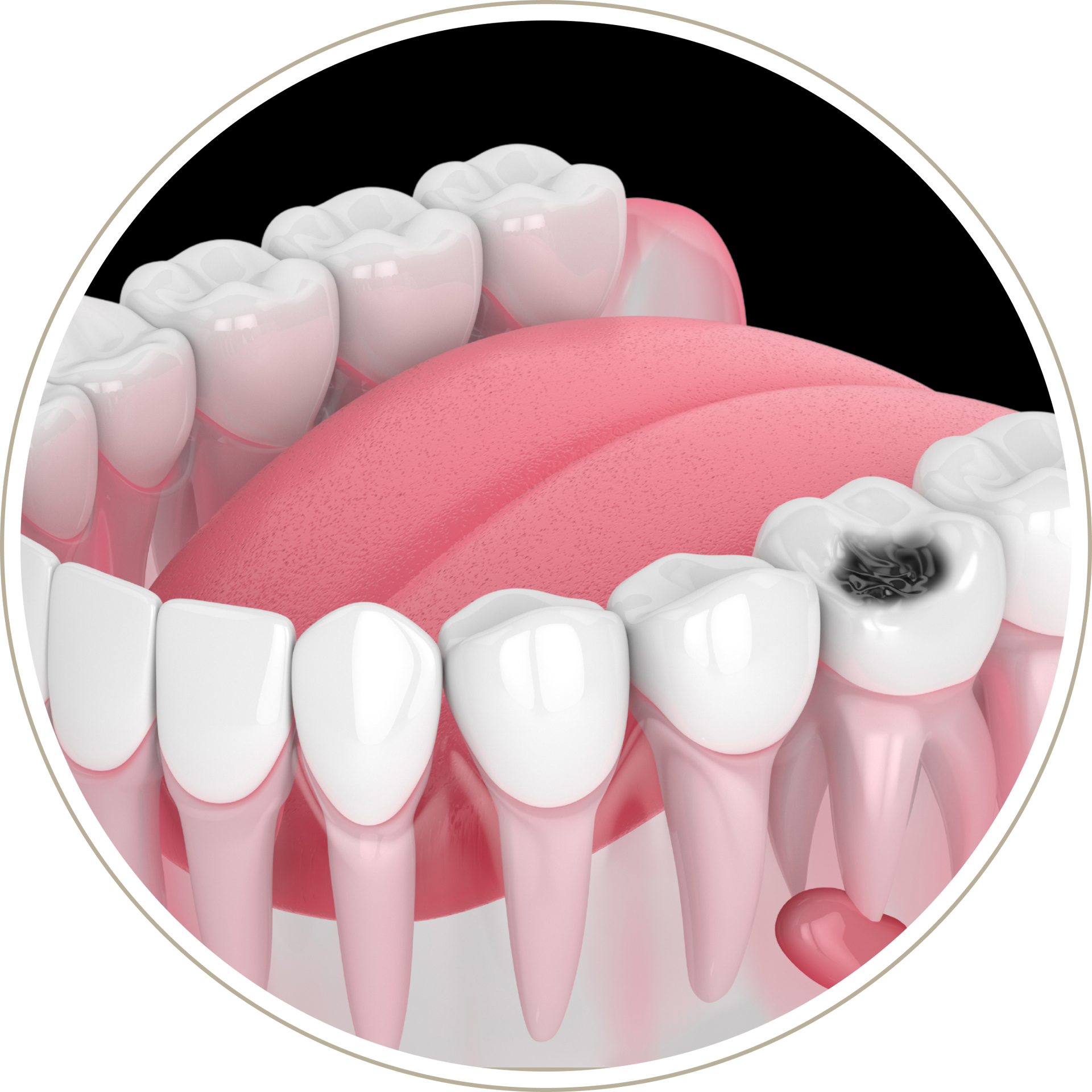 A computer generated image of a person 's teeth with dental implants.