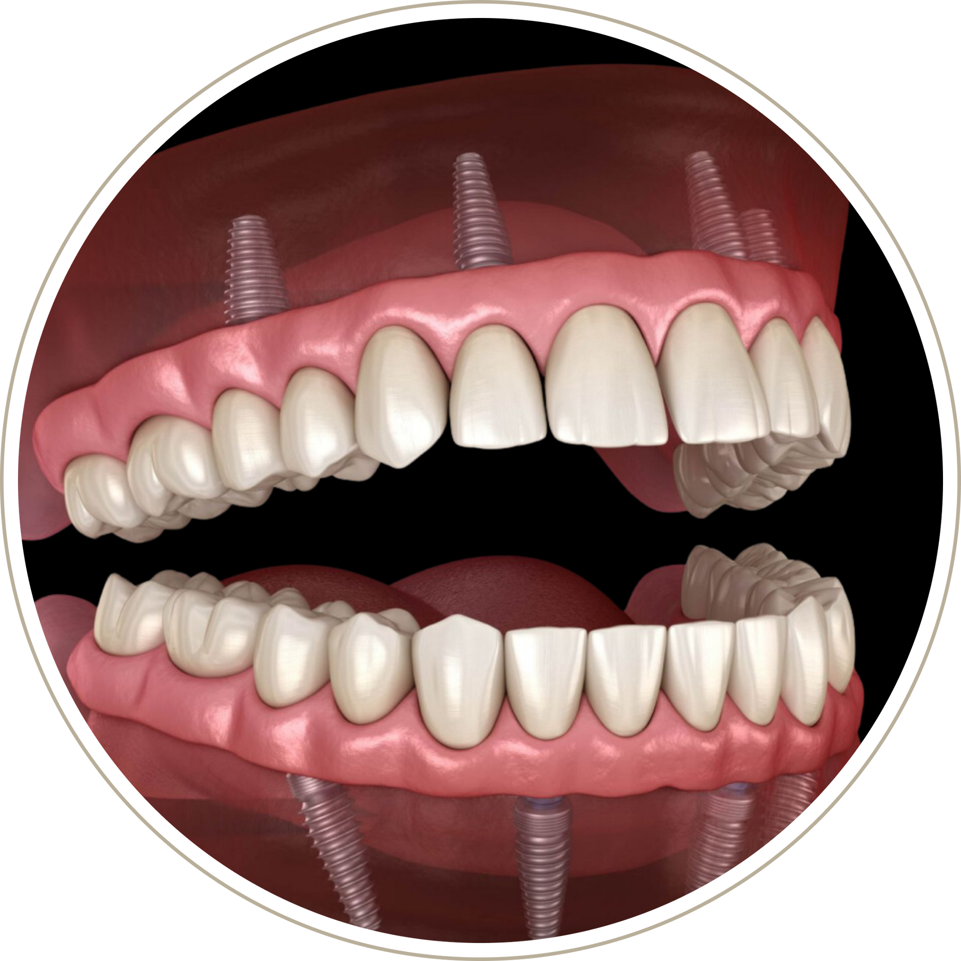 A computer generated image of a person 's teeth with dental implants.