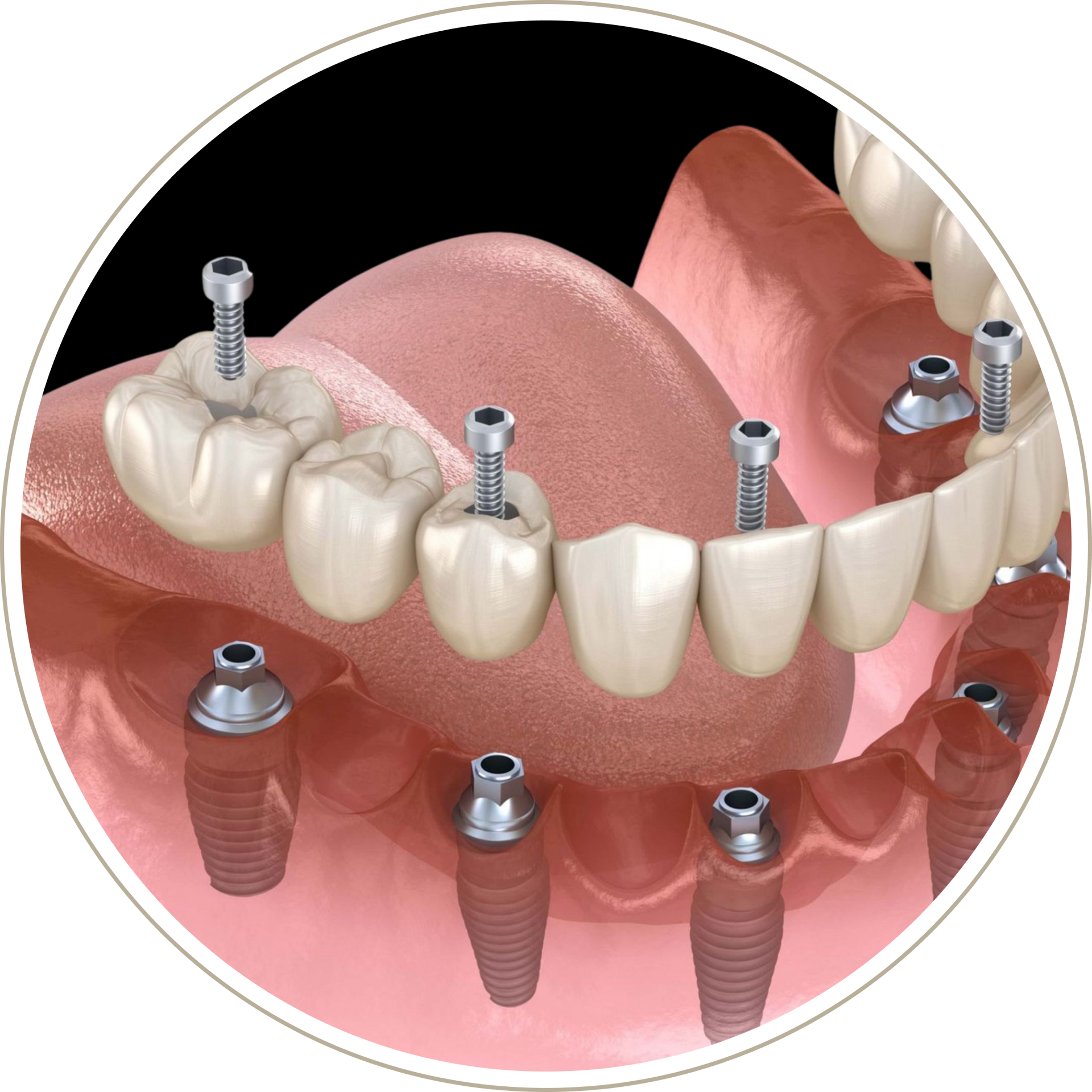 A computer generated image of a person 's teeth with dental implants.