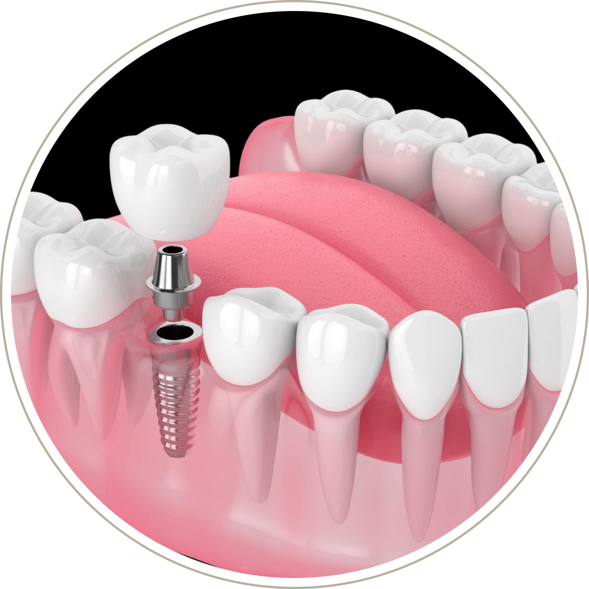 A computer generated image of a person 's teeth with dental implants.