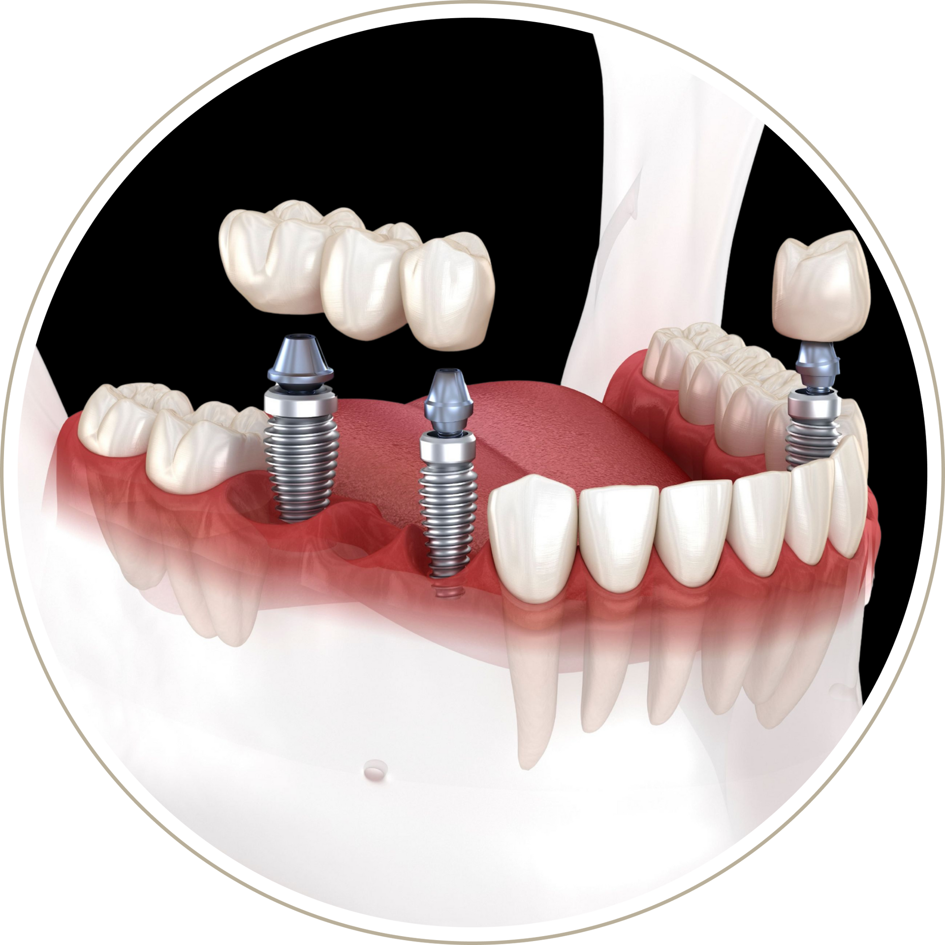 A computer generated image of a person 's teeth with dental implants.