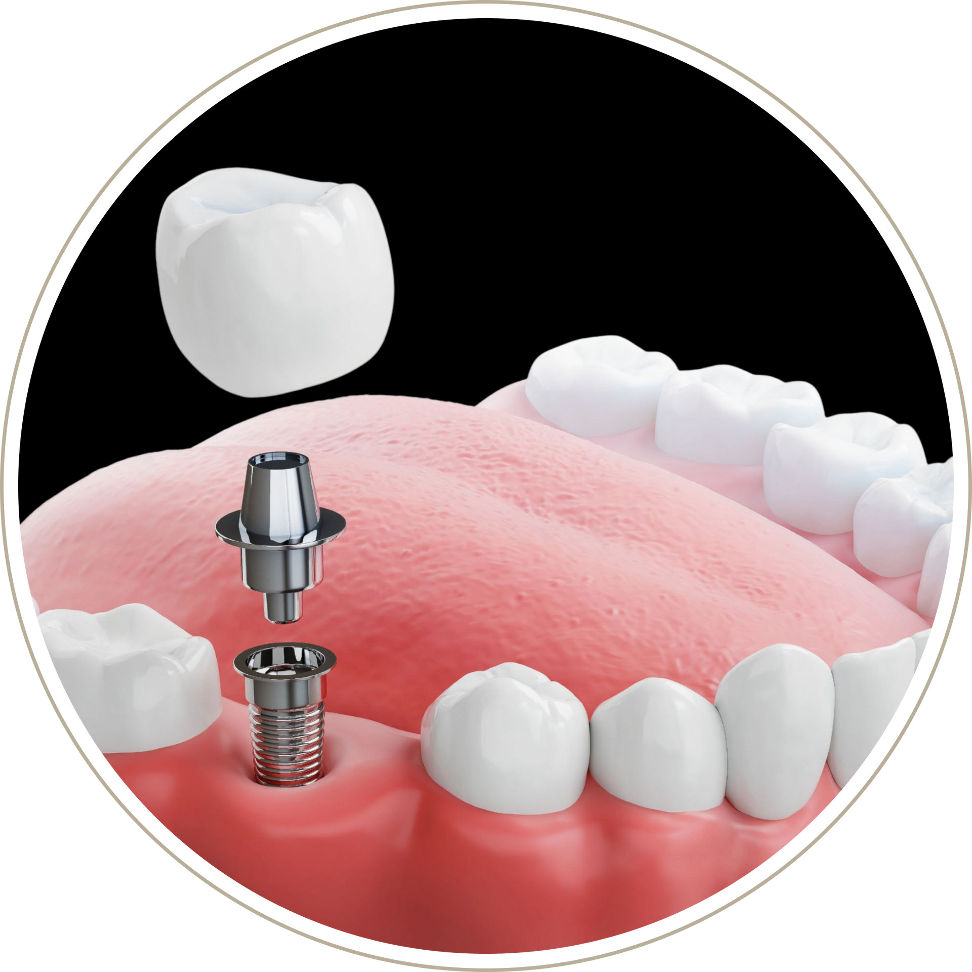 A computer generated image of a person 's teeth with dental implants.