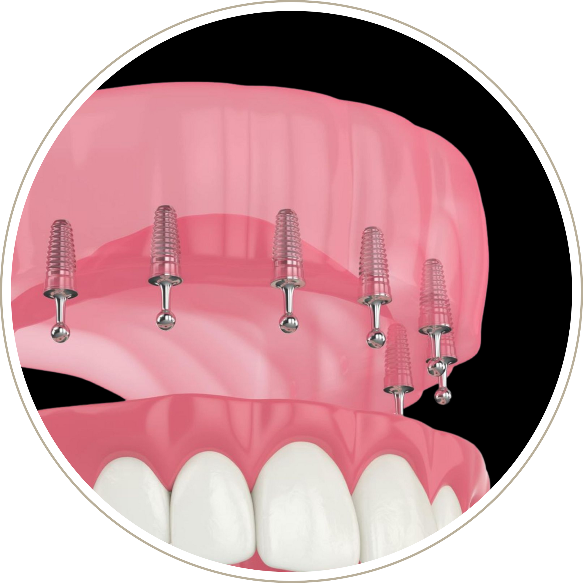 A computer generated image of a person 's teeth with dental implants.