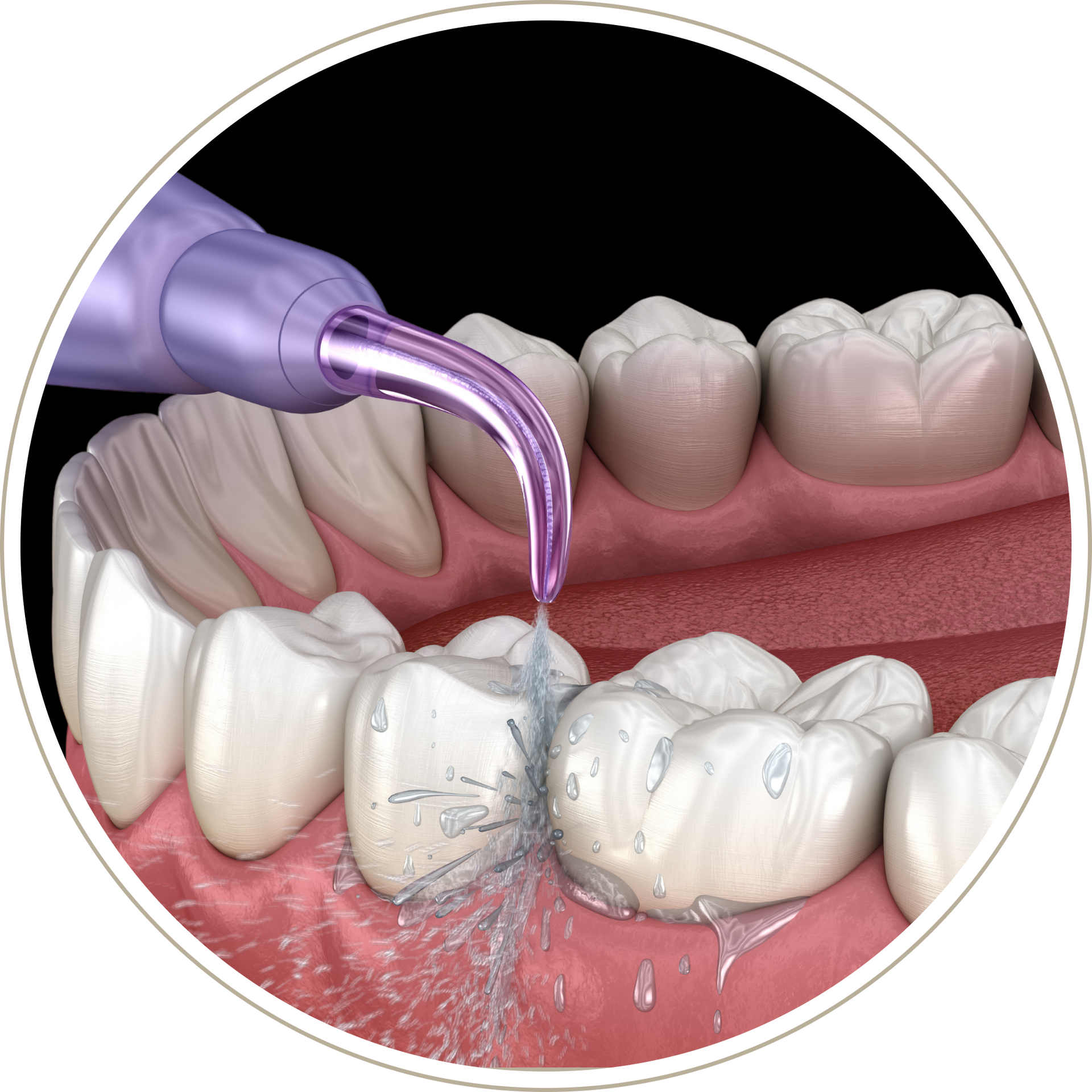 A computer generated image of a person 's teeth with dental implants.