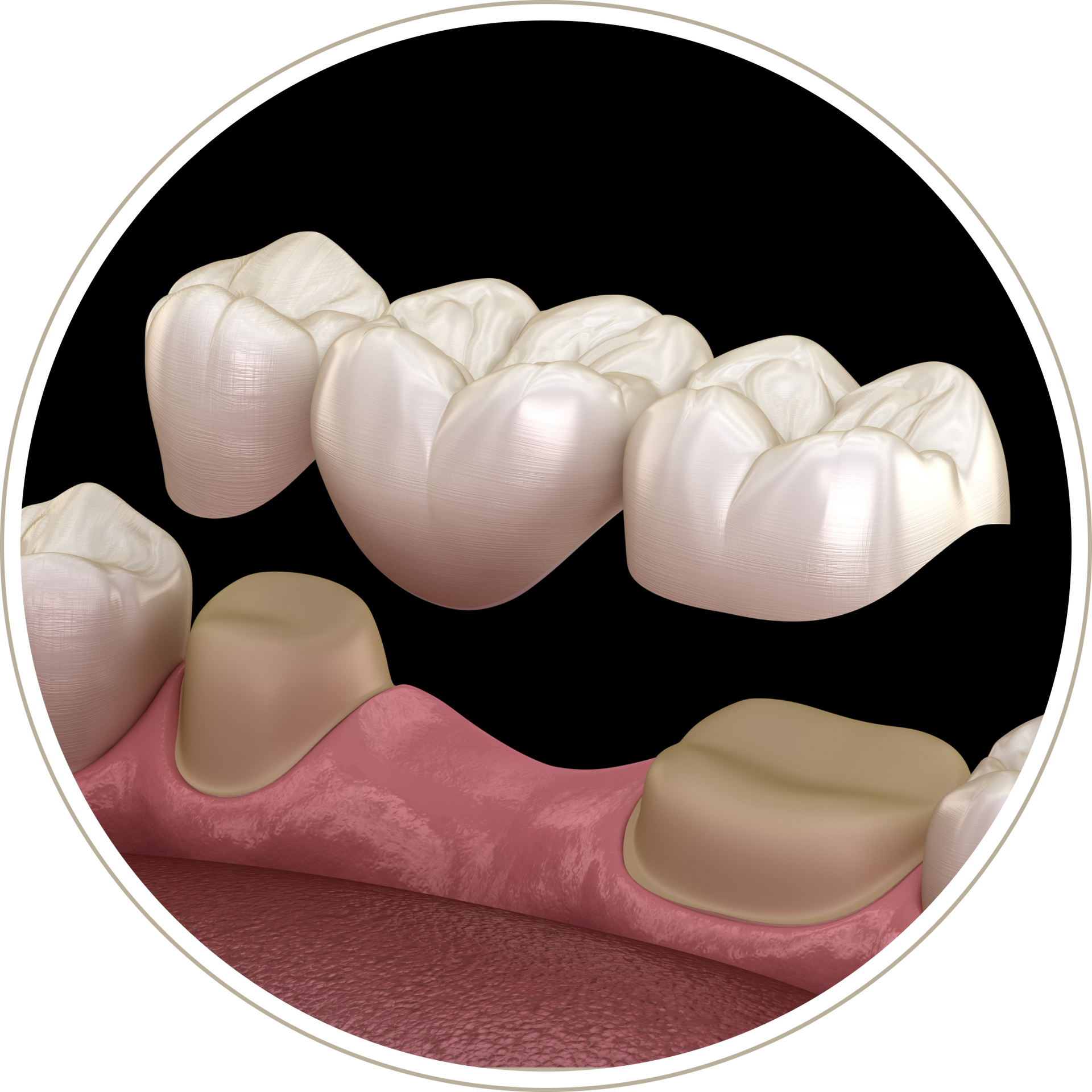 A computer generated image of a person 's teeth with dental implants.