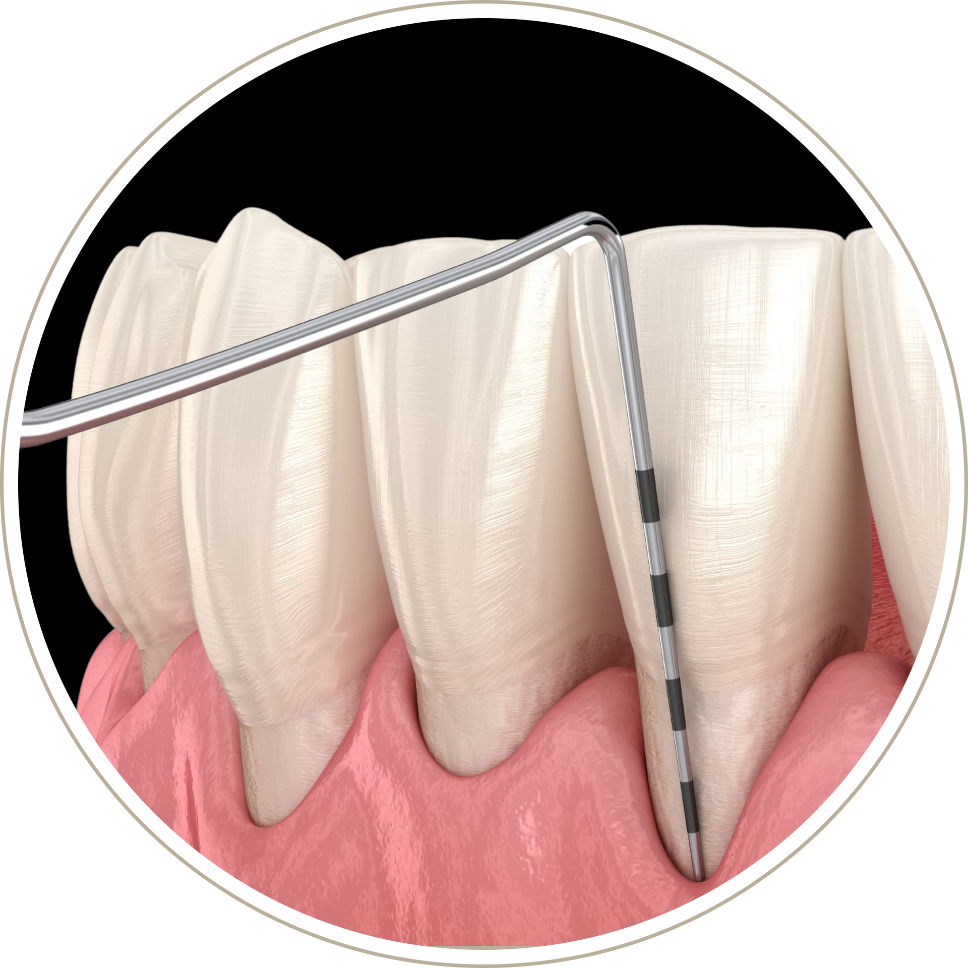 A computer generated image of a person 's teeth with dental implants.