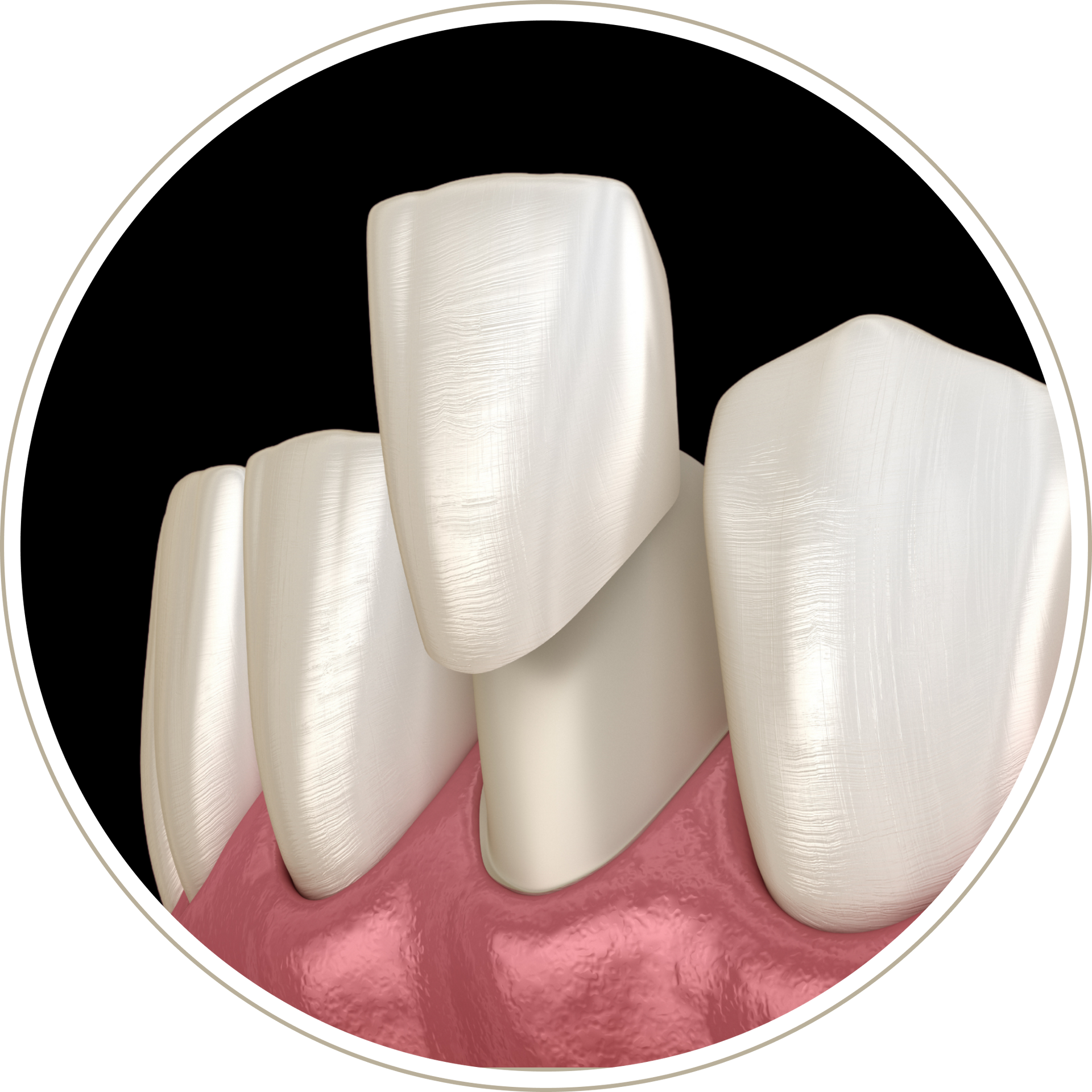 A computer generated image of a person 's teeth with dental implants.