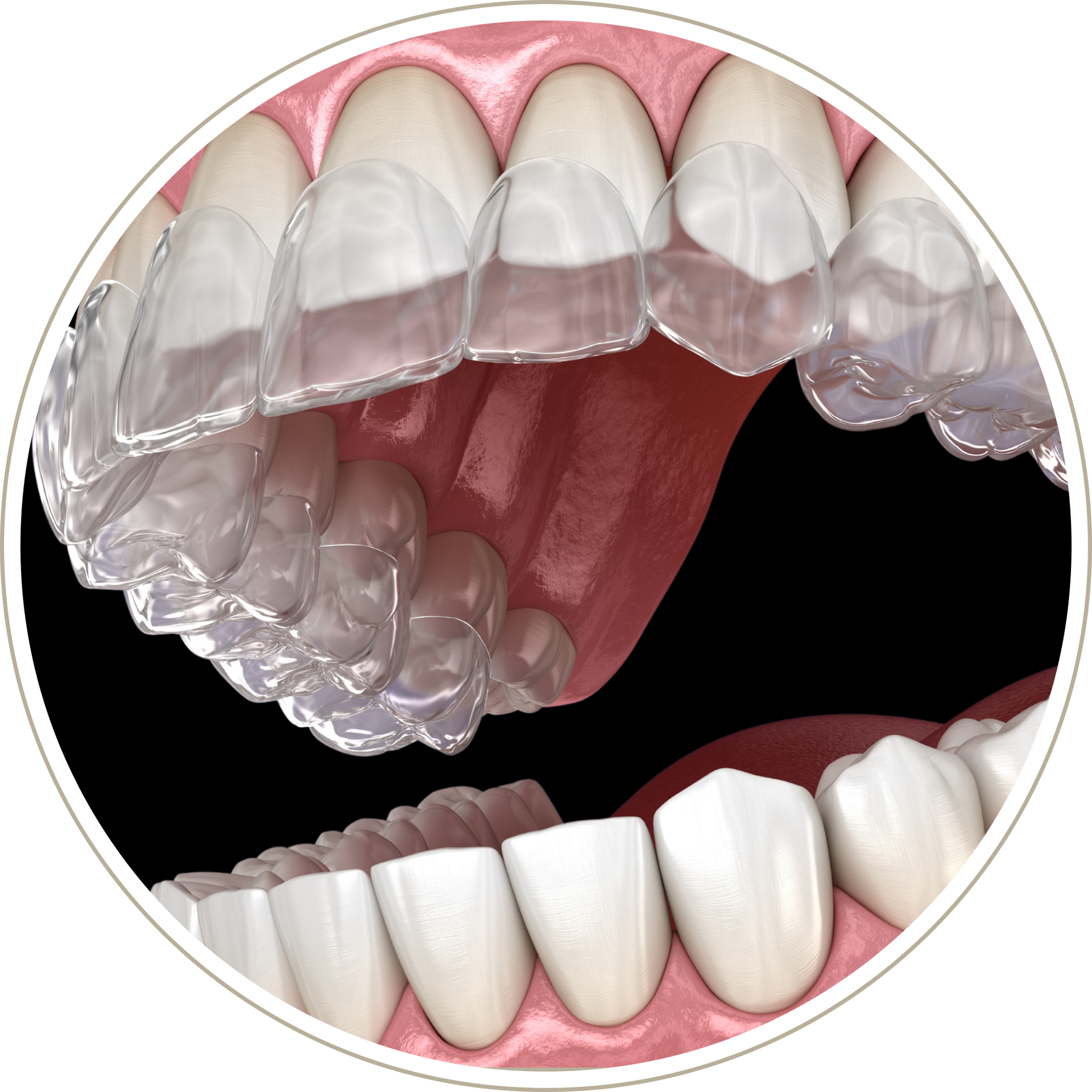 A computer generated image of a person 's teeth with dental implants.