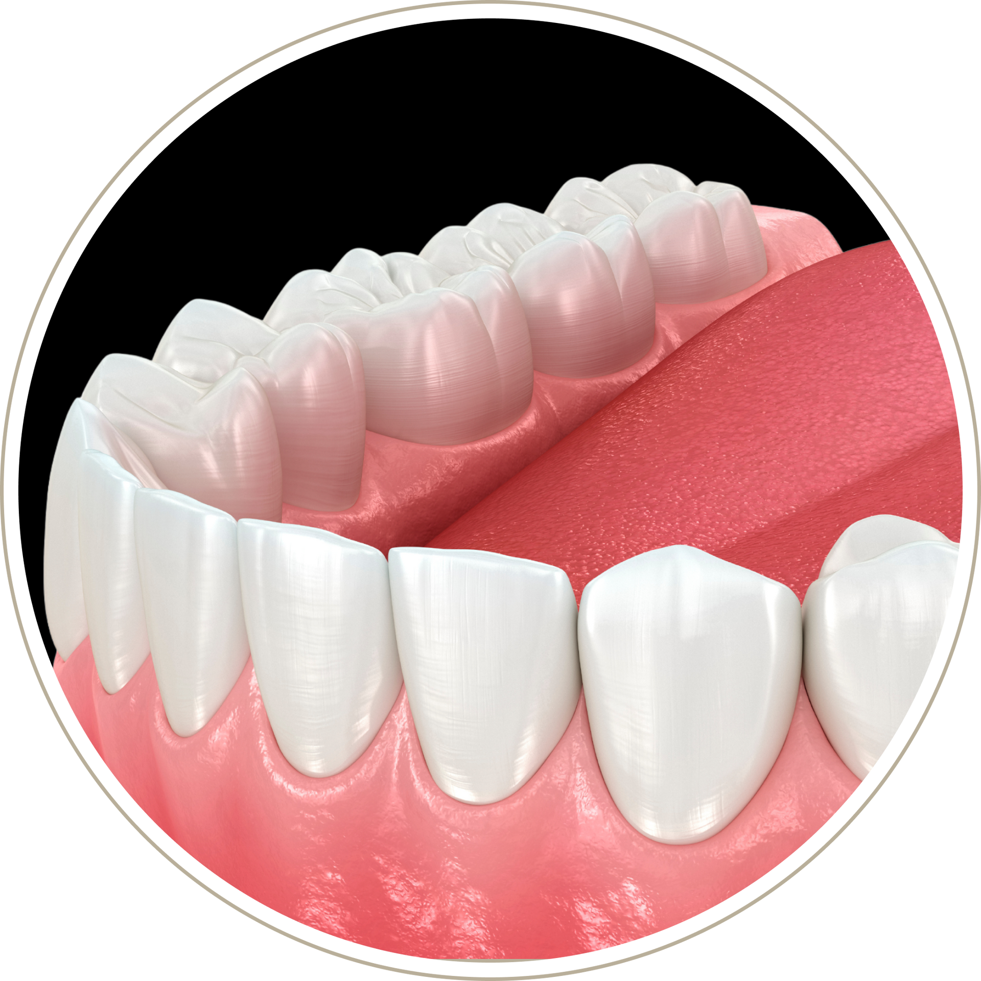 A computer generated image of a person 's teeth with dental implants.