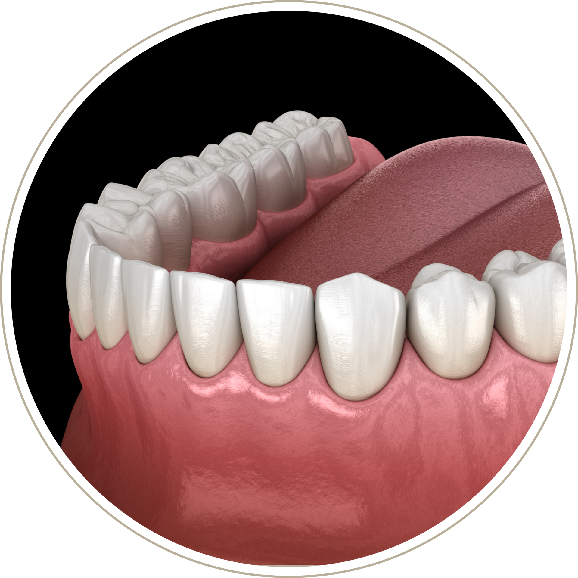 A computer generated image of a person 's teeth with dental implants.