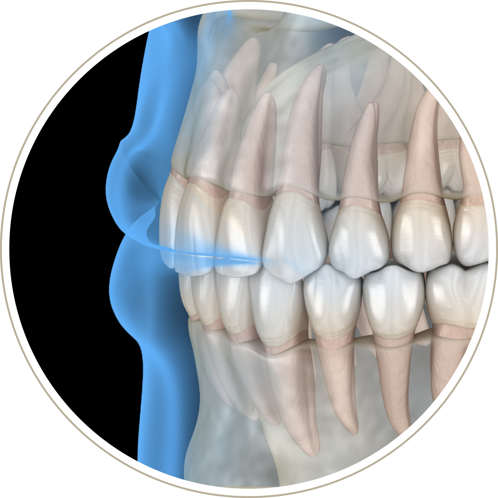 A computer generated image of a person 's teeth with dental implants.