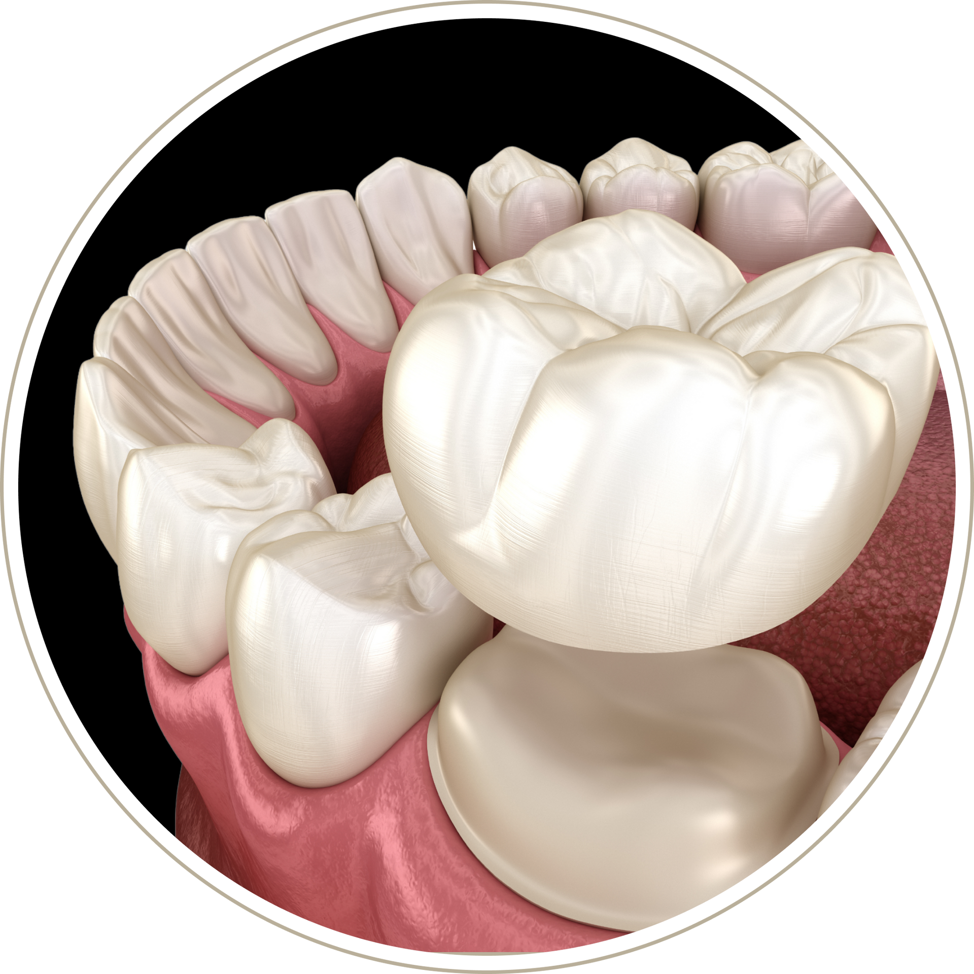 A computer generated image of a person 's teeth with dental implants.