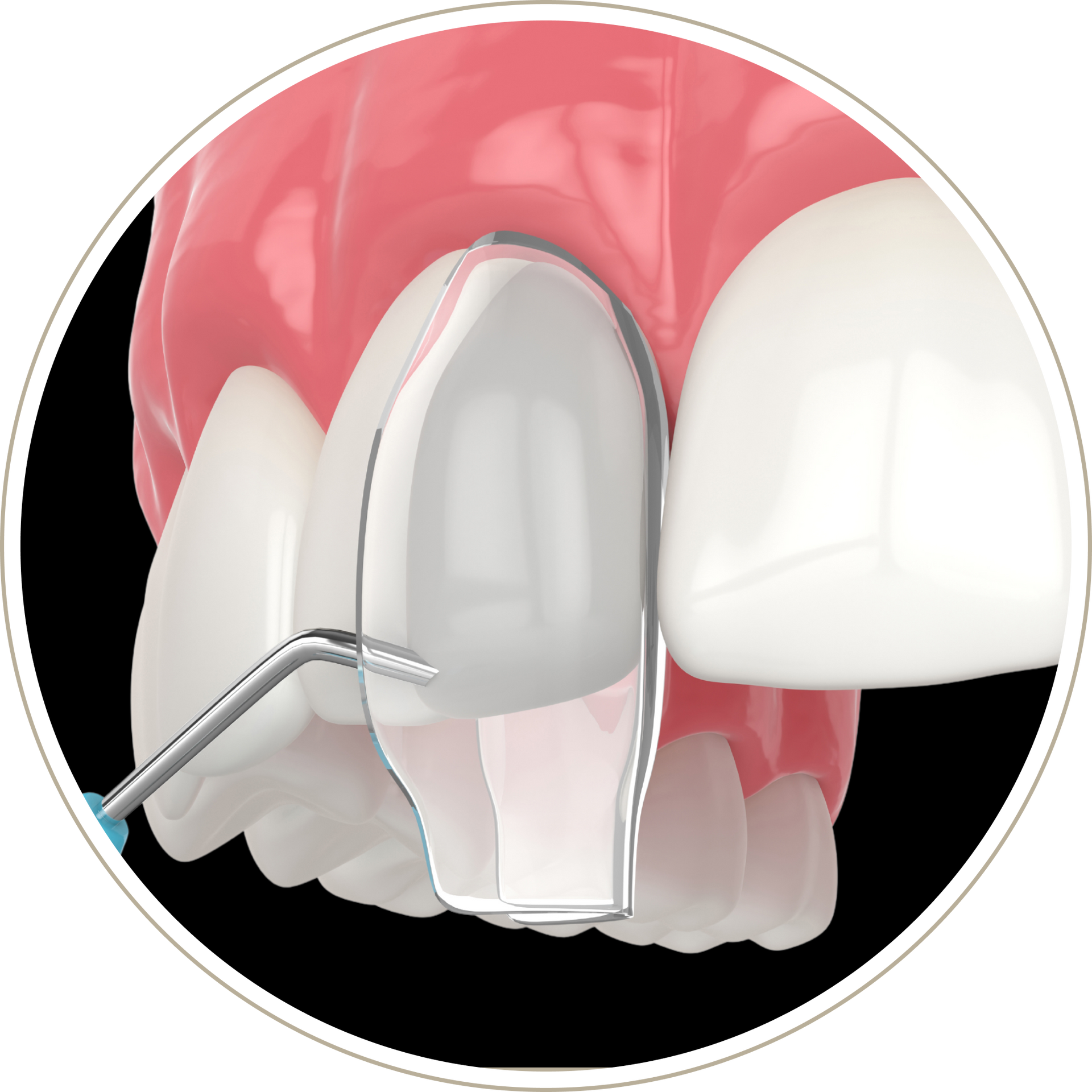 A computer generated image of a person 's teeth with dental implants.