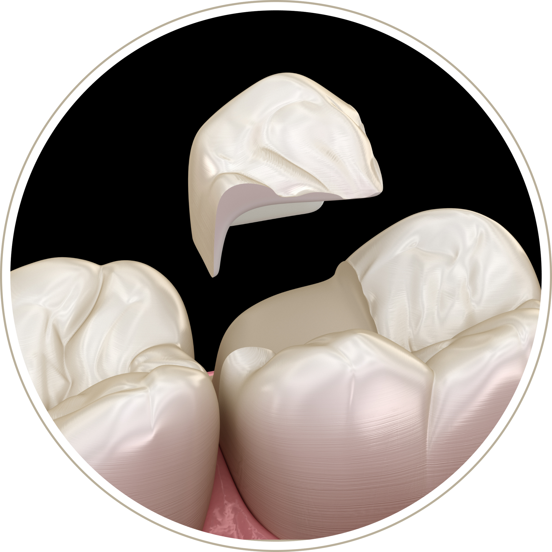 A computer generated image of a person 's teeth with dental implants.