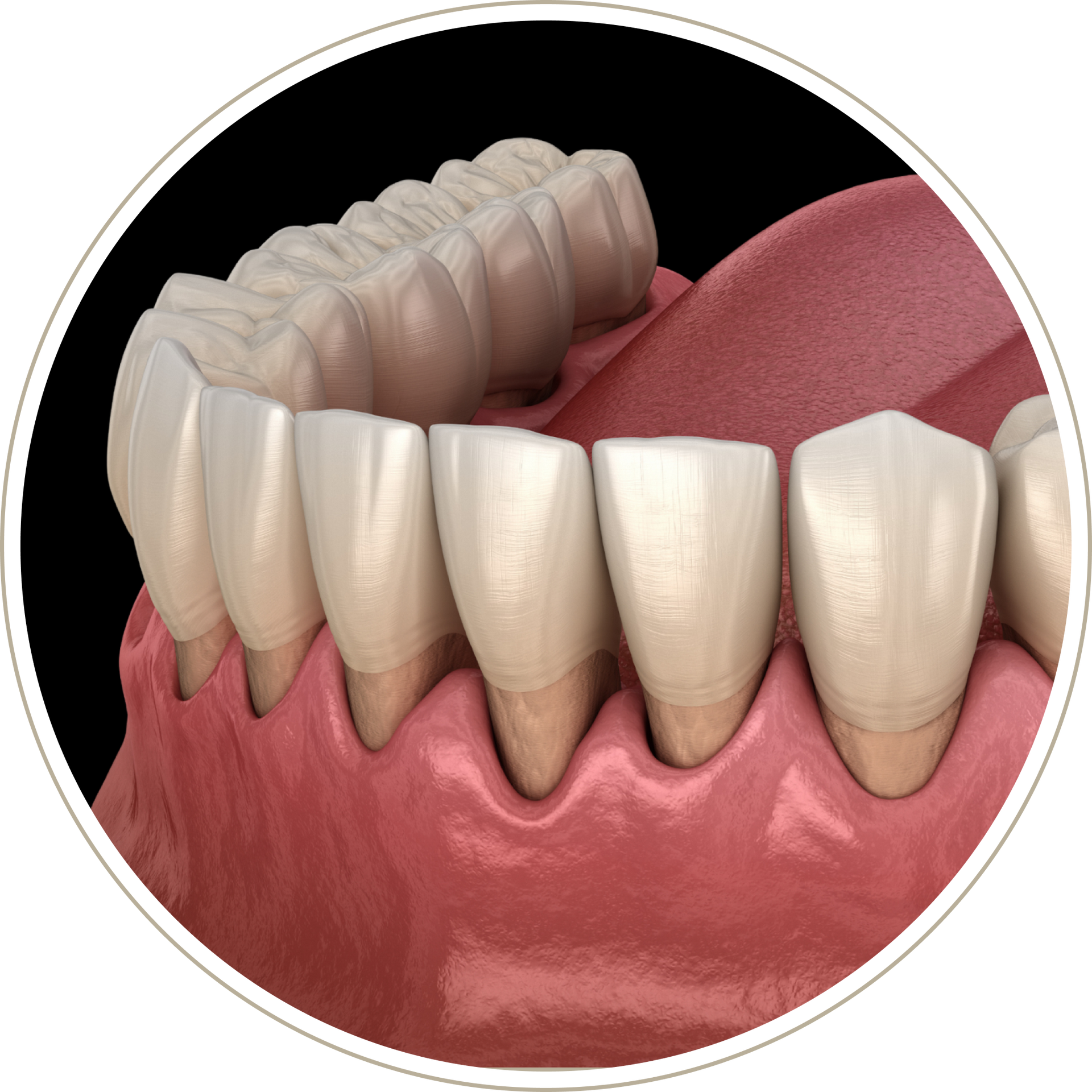 A computer generated image of a person 's teeth with dental implants.