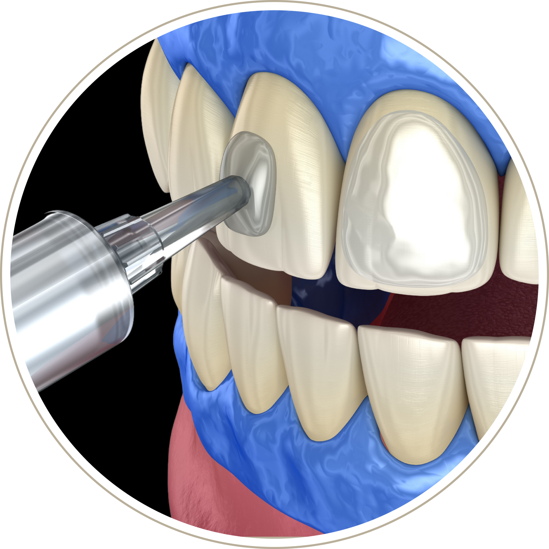 A computer generated image of a person 's teeth with dental implants.