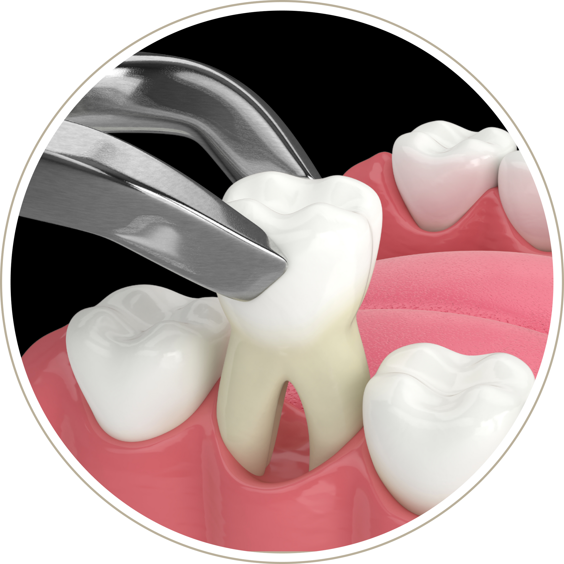 A computer generated image of a person 's teeth with dental implants.