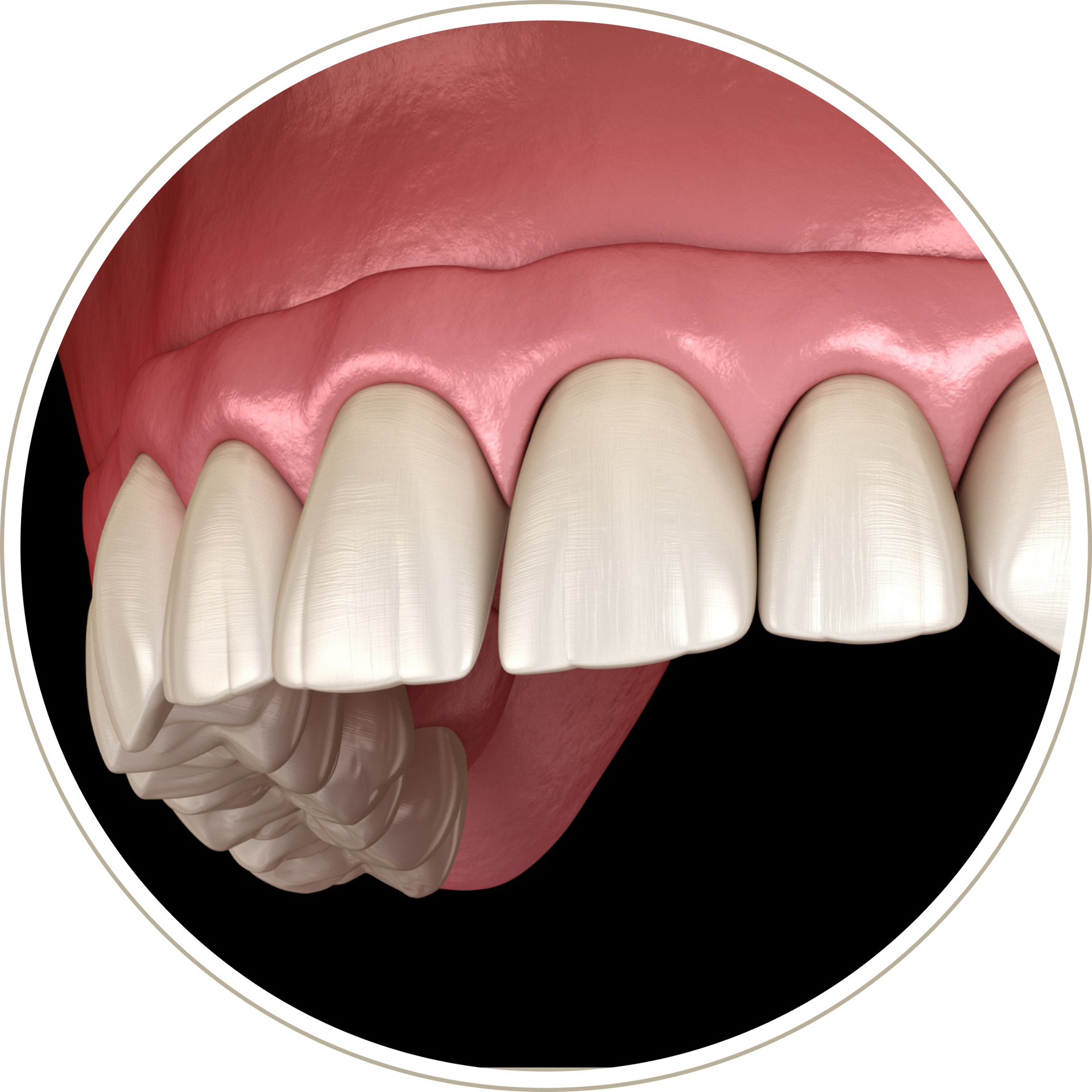 A computer generated image of a person 's teeth with dental implants.