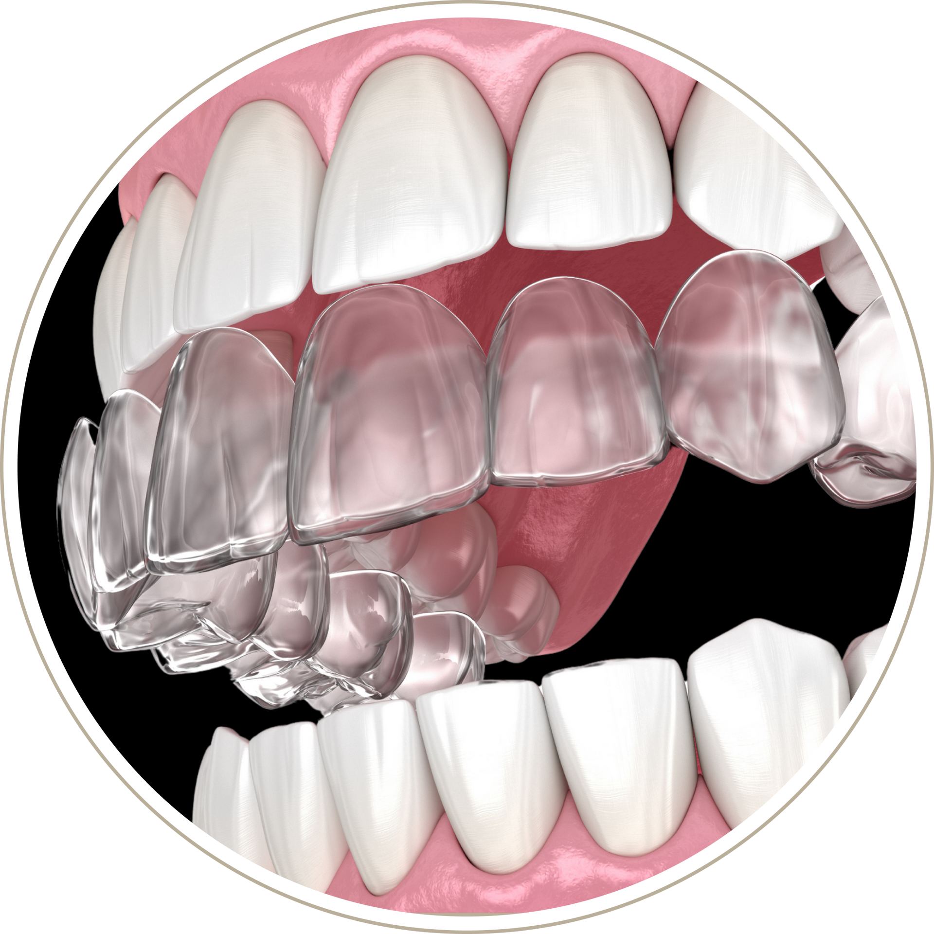 A computer generated image of a person 's teeth with dental implants.