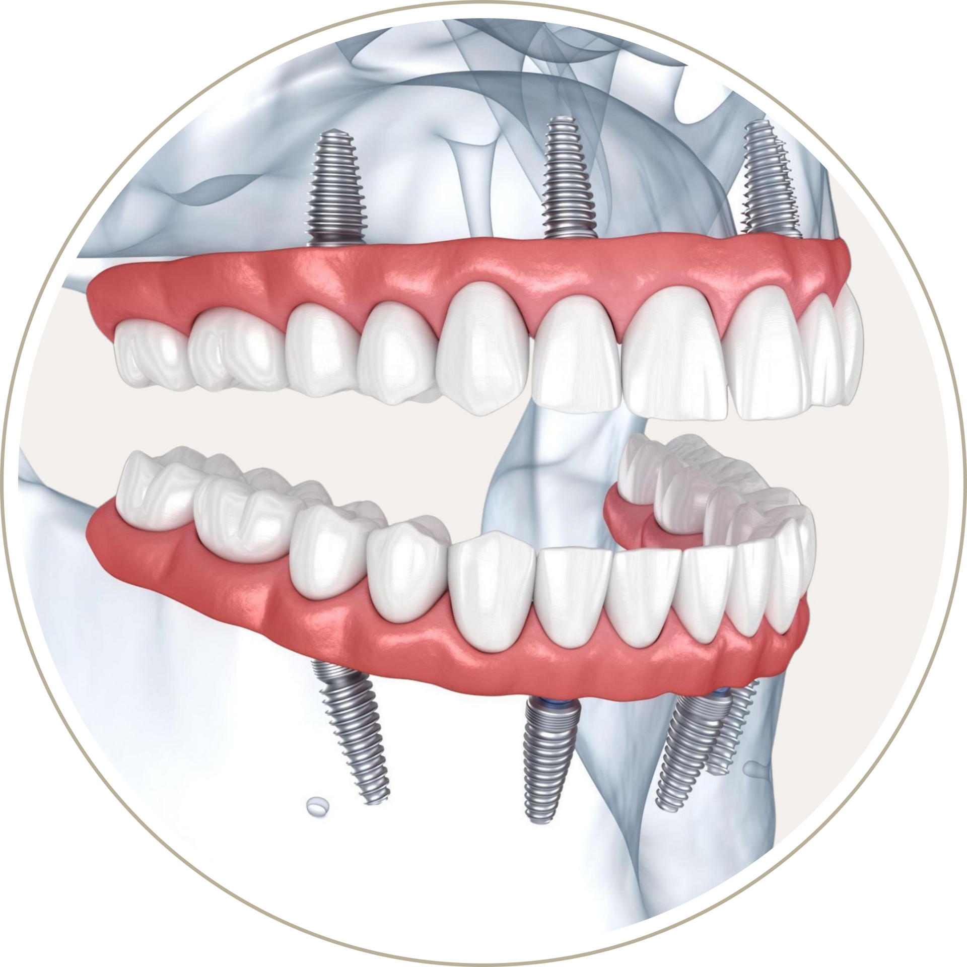 A computer generated image of a person 's teeth with dental implants.