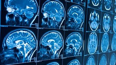 A Traumatic Brain Injury Can Impact Key Areas of Your Life