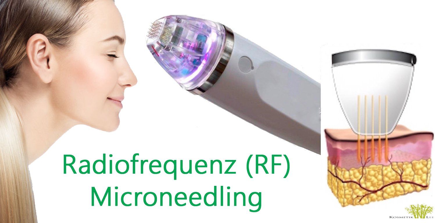 Radiofrequenz Microeedling