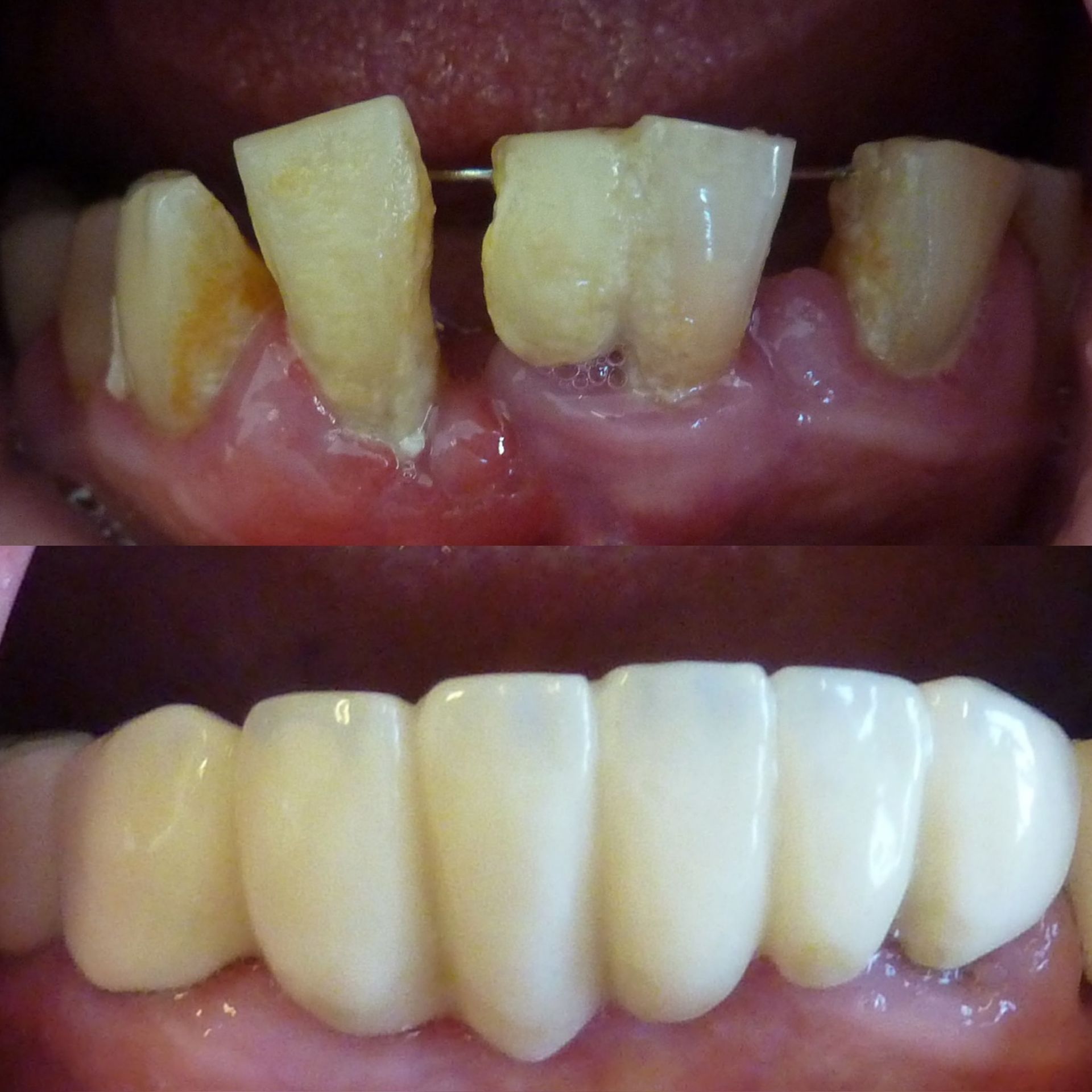 Une photo avant et après des dents d'une personne