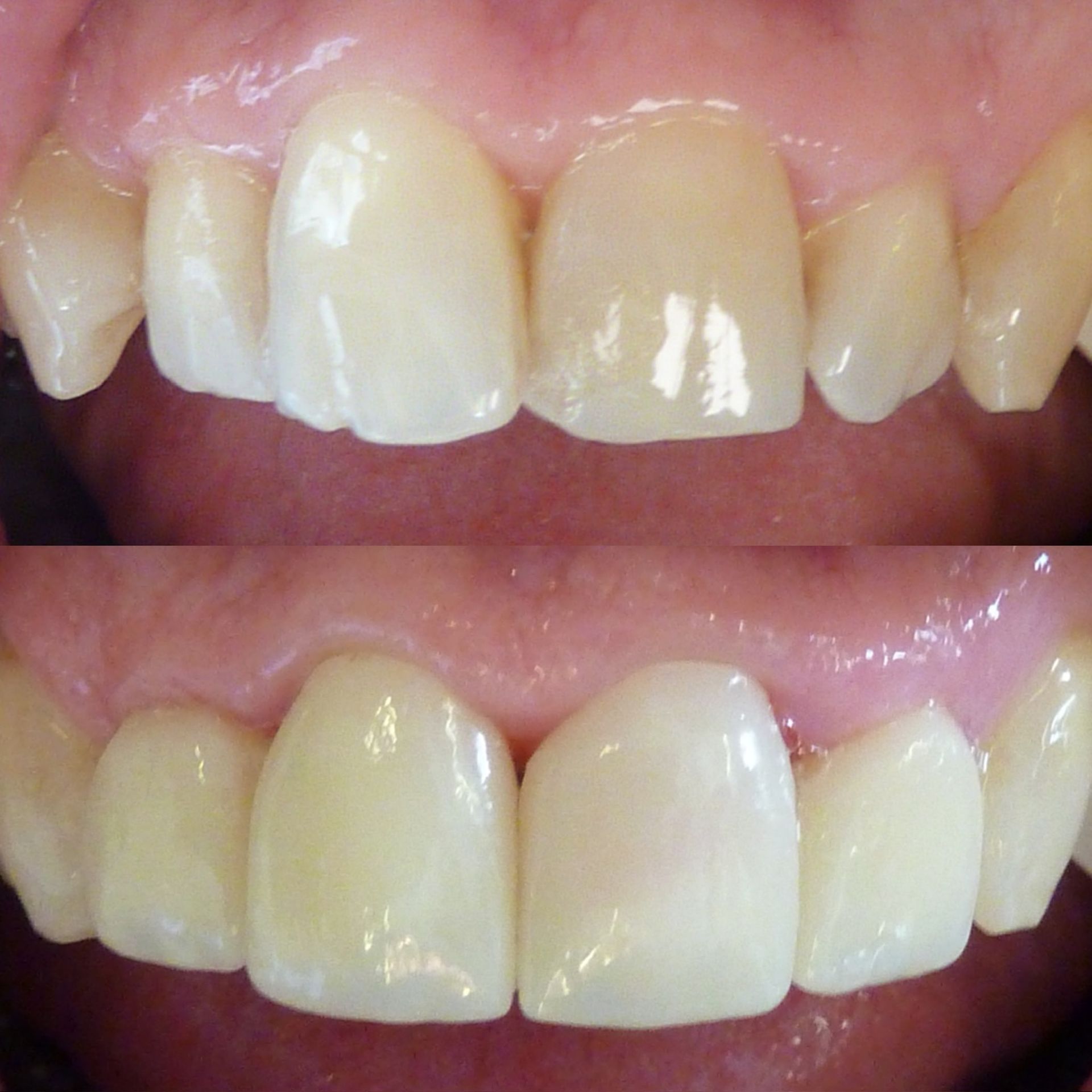 Une photo avant et après des dents d'une personne