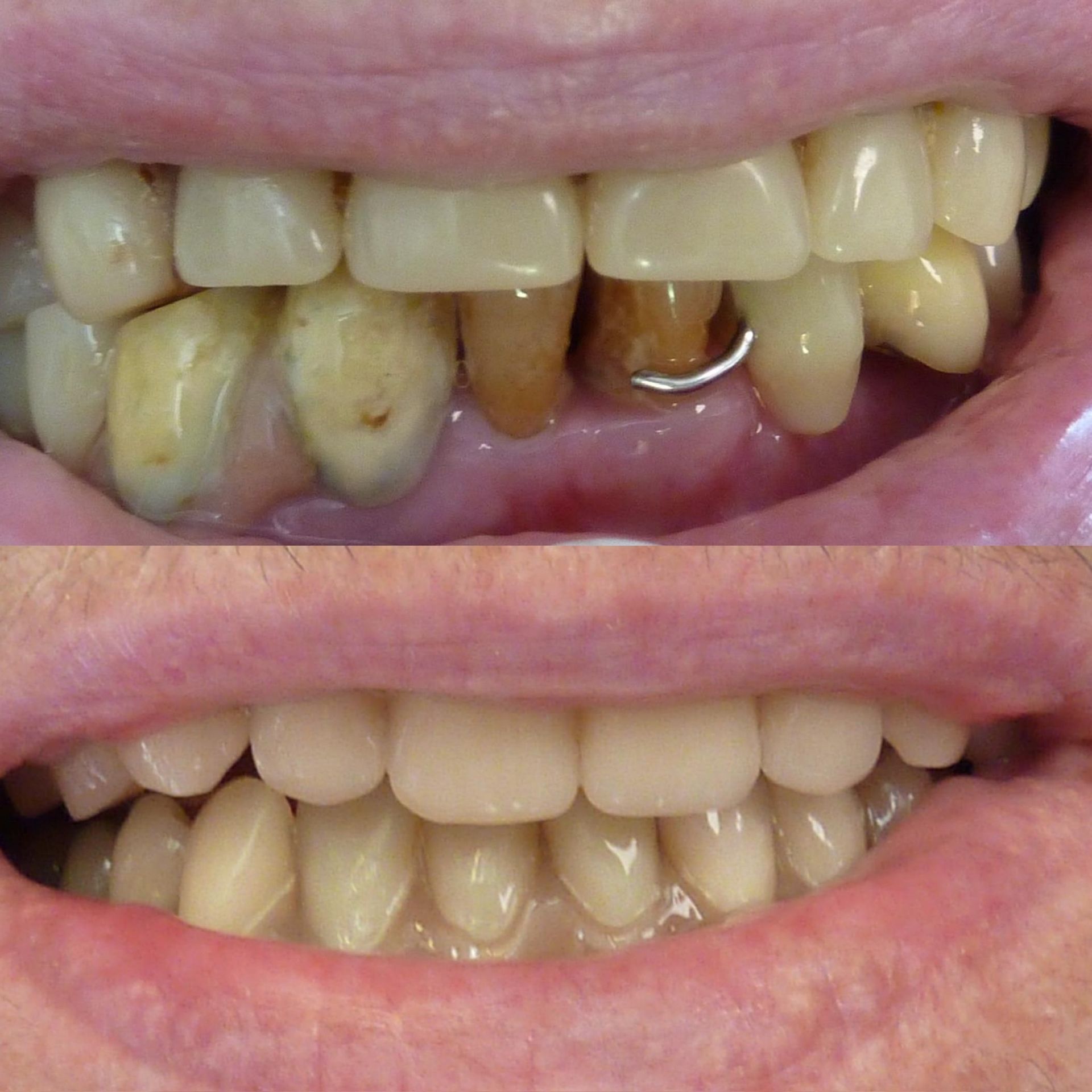 Une photo avant et après des dents d'une personne