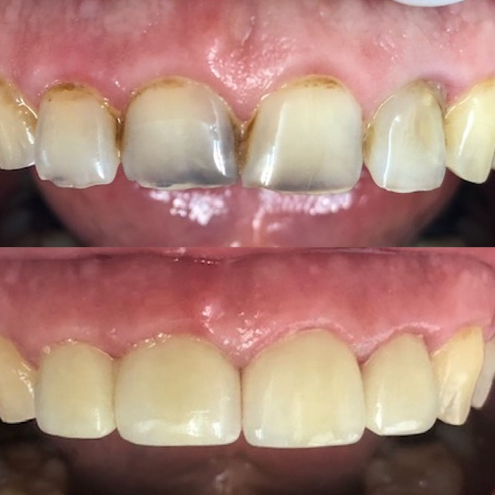 Une photo avant et après des dents d'une personne.